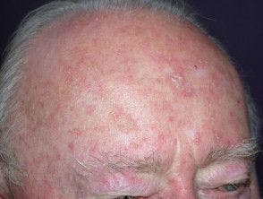 Close up of elderly man with actinic keratosis on the forehead and head