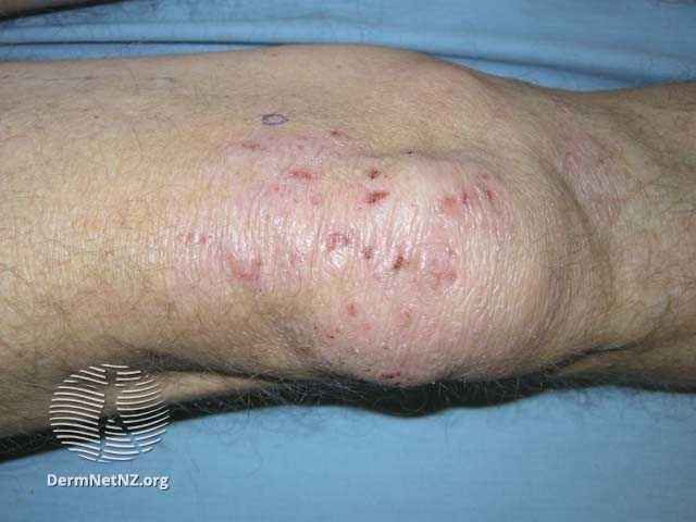 Atopic eczema on the knee with clear excoriations and lichenification. Image courtesy of DermNet