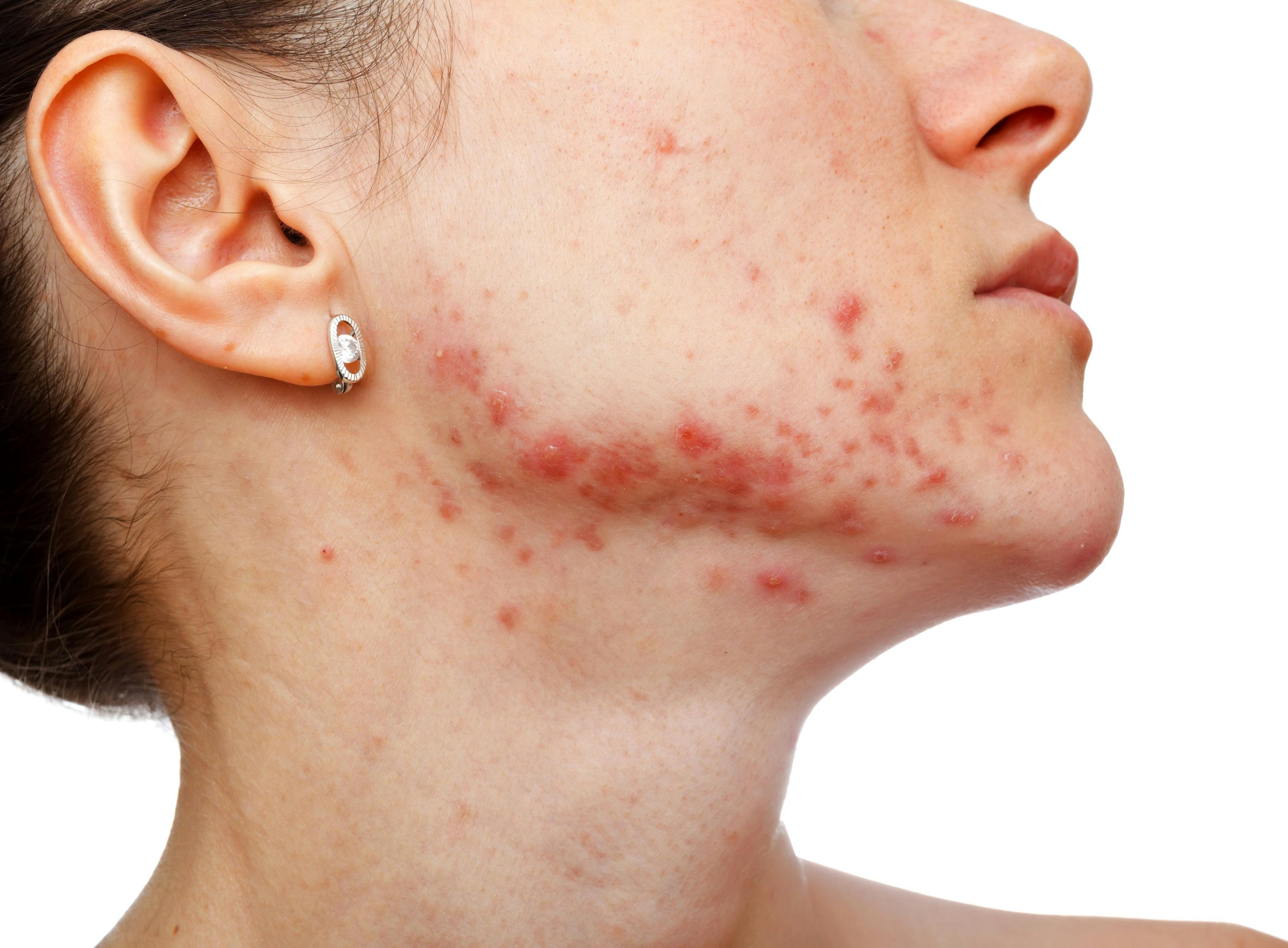 Research Finds Dermatology Visits for Acne Higher in Adult Female Patients