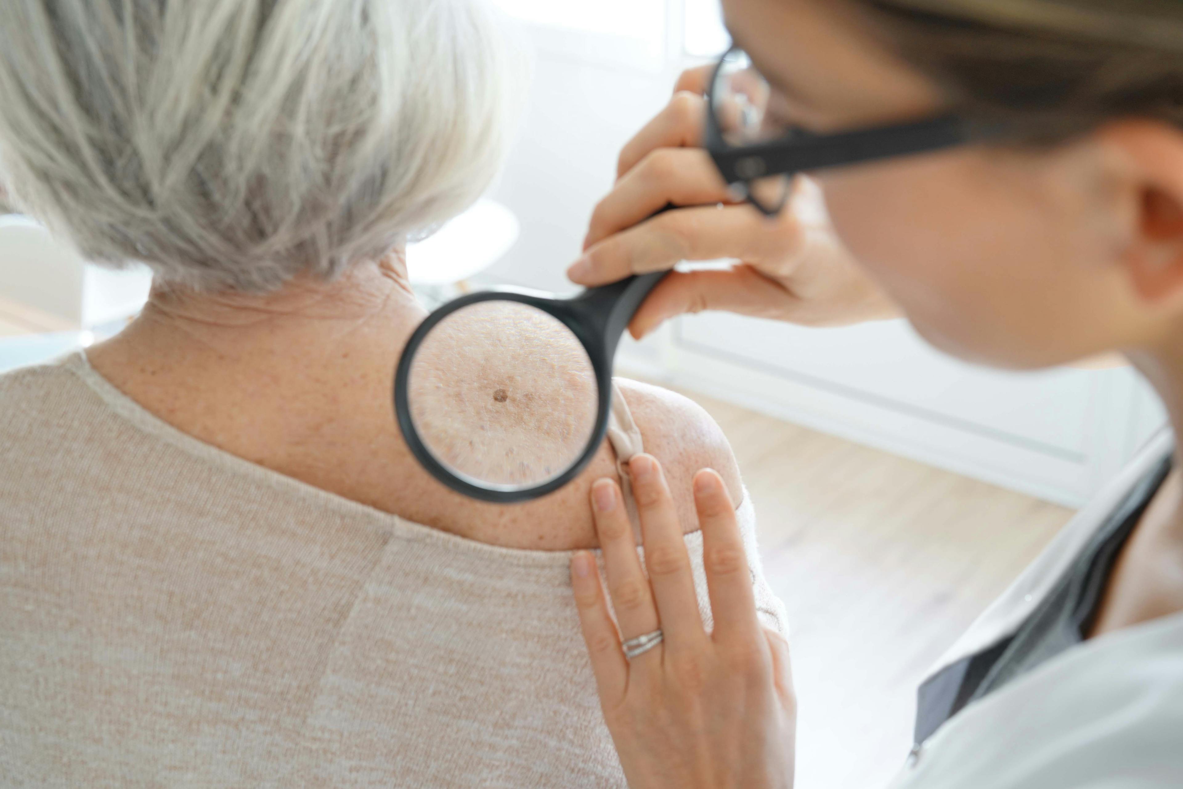 COVID-19's Impact on Treating Elderly Patients With Skin Cancer