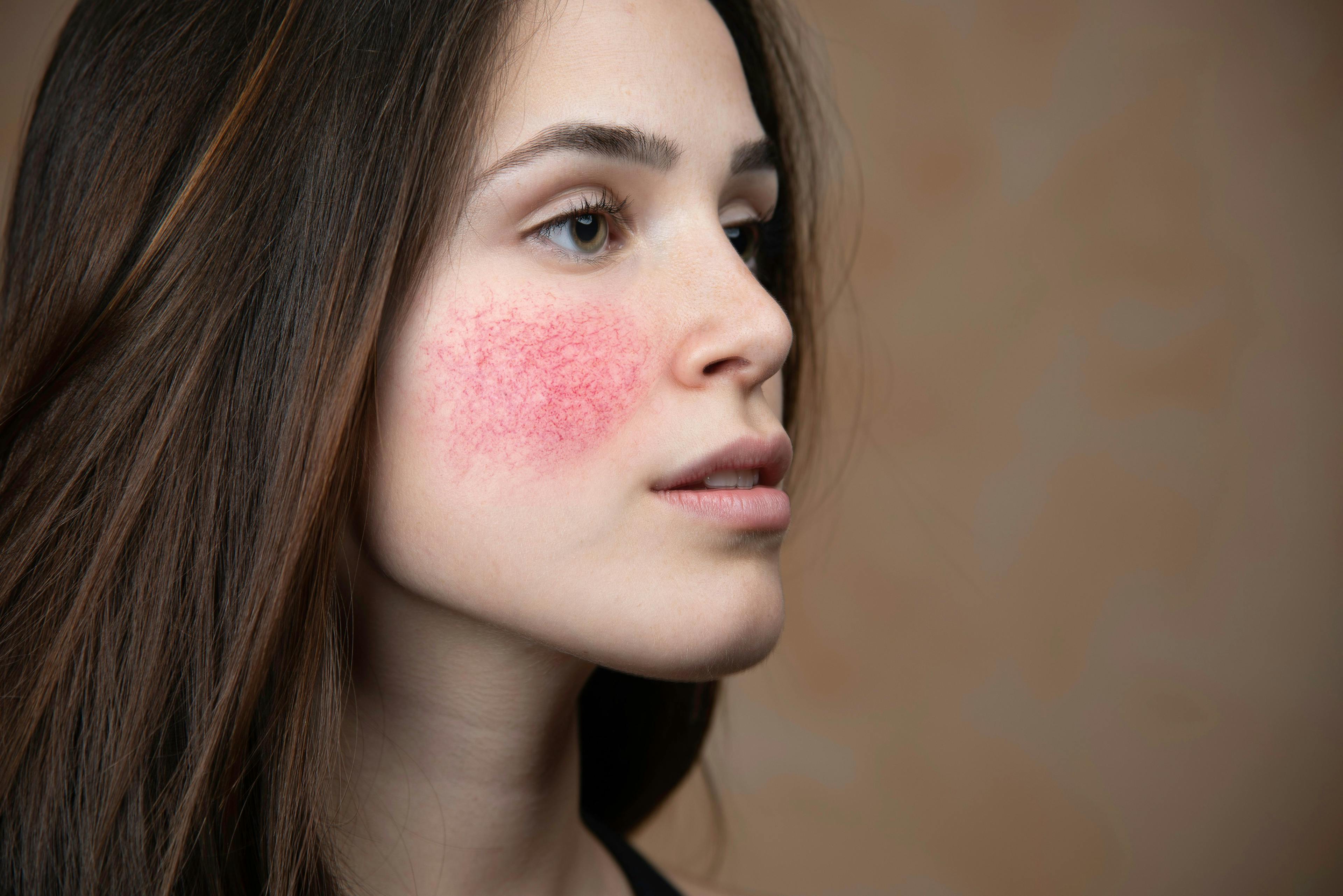 Microencapsulated Benzoyl Peroxide Reduces Rosacea Lesions