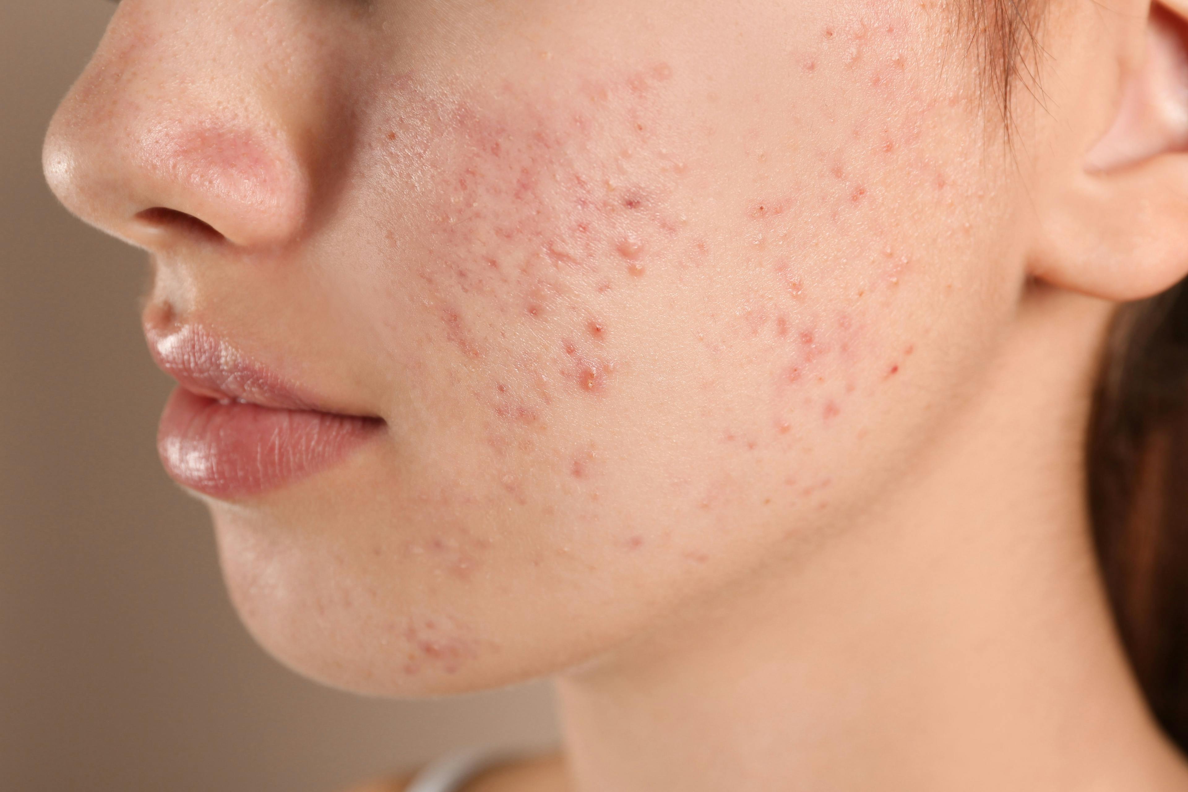 New Pediatric Perspectives for Acne