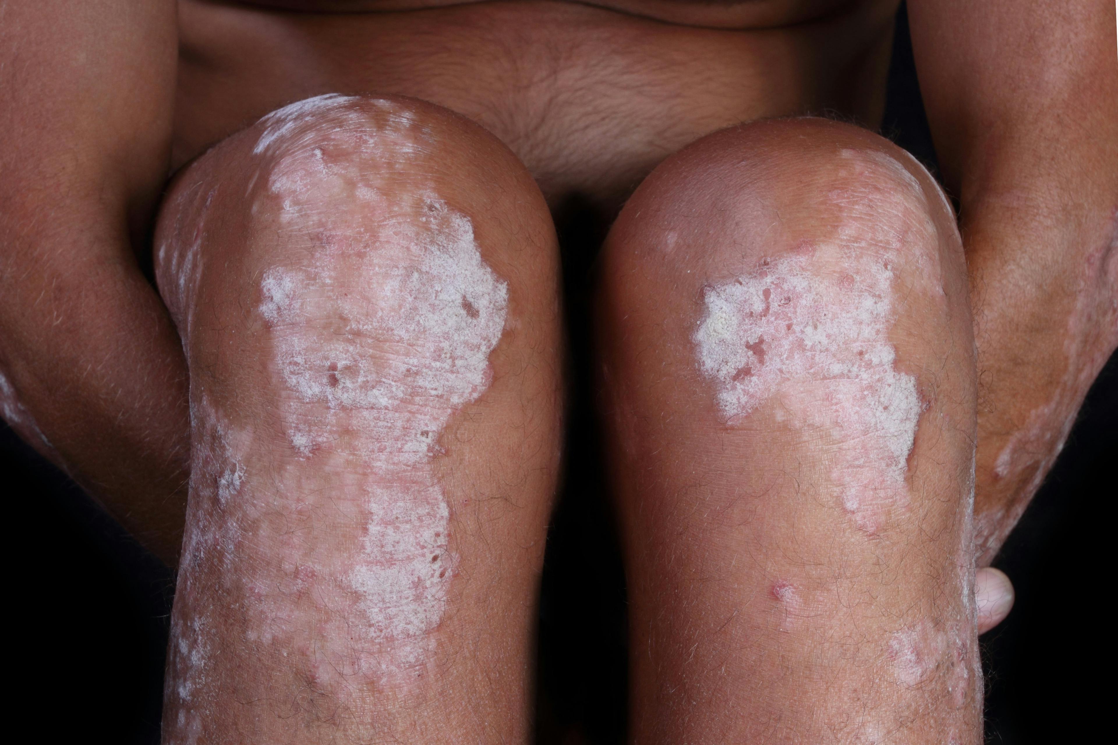 patches of dry, flaky skin on knees