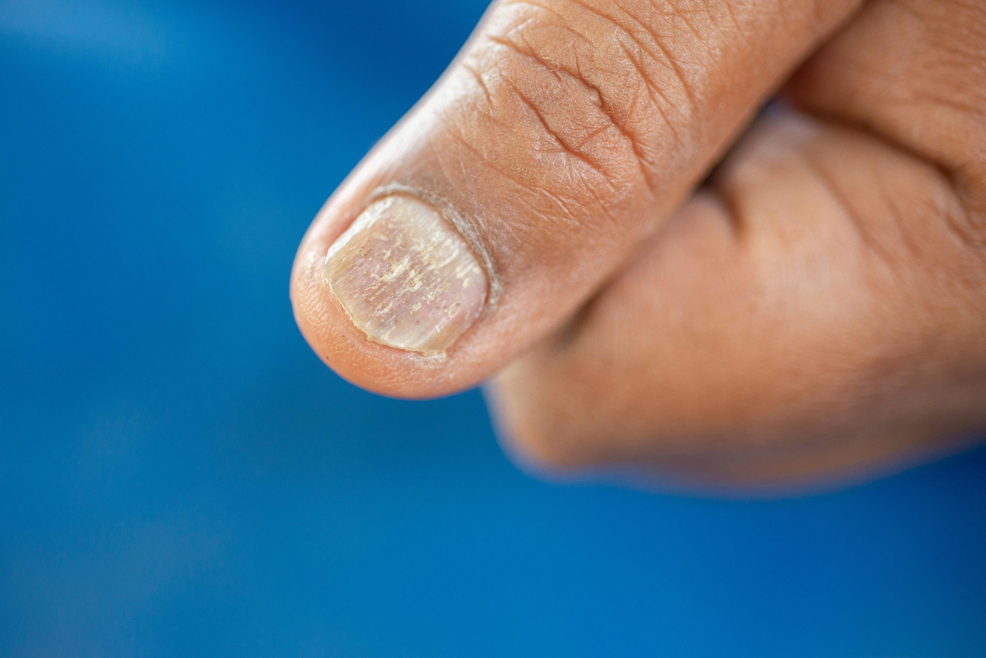 An Overview of  Nail Psoriasis