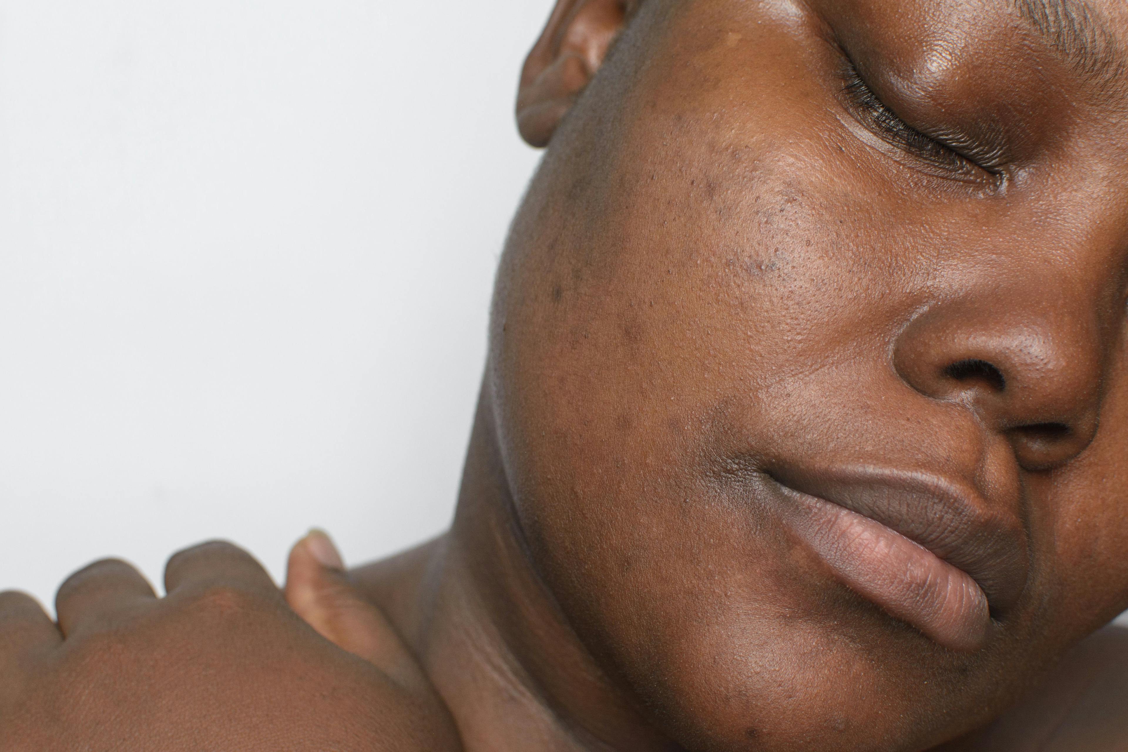Tazarotene Led to Hyperpigmentation Improvement in Black Patients With Acne