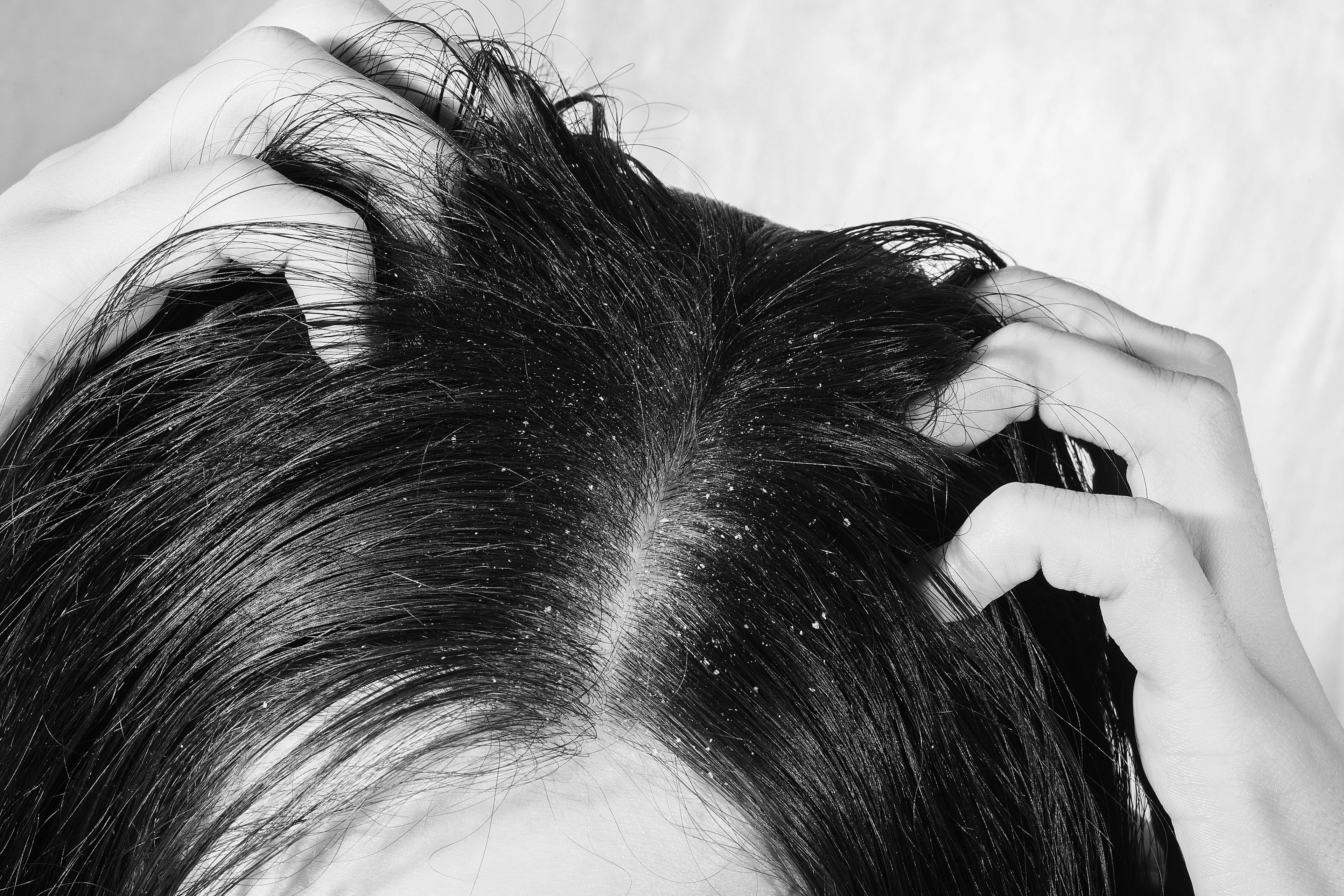 Keratolytic and Hydrating Shampoo Improves Signs of Scalp Psoriasis