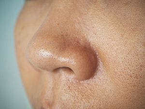 Case series draws attention to phenotype of acne scarring 