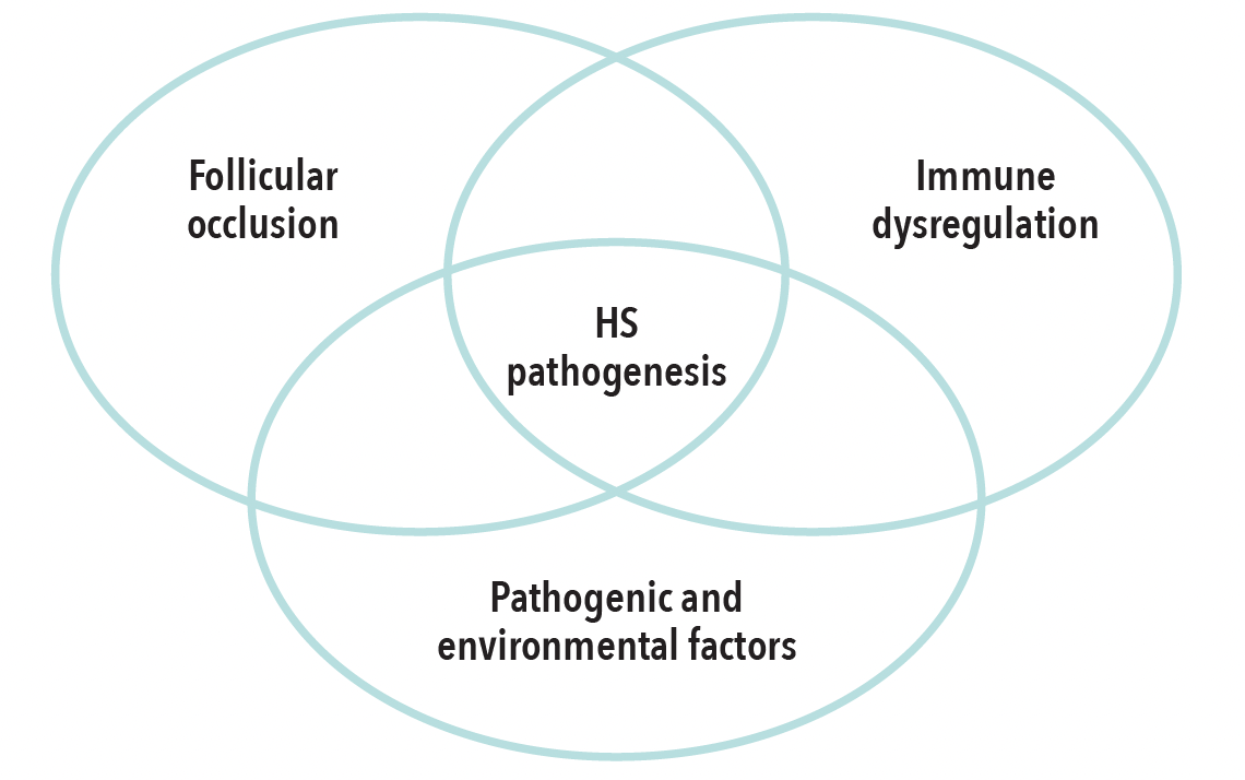 The HS pathogenesis is complex and multifaceted.