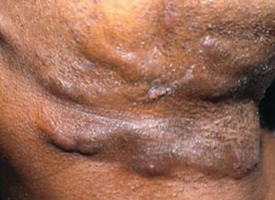 Figure 1: Axilla of adolescent with HS