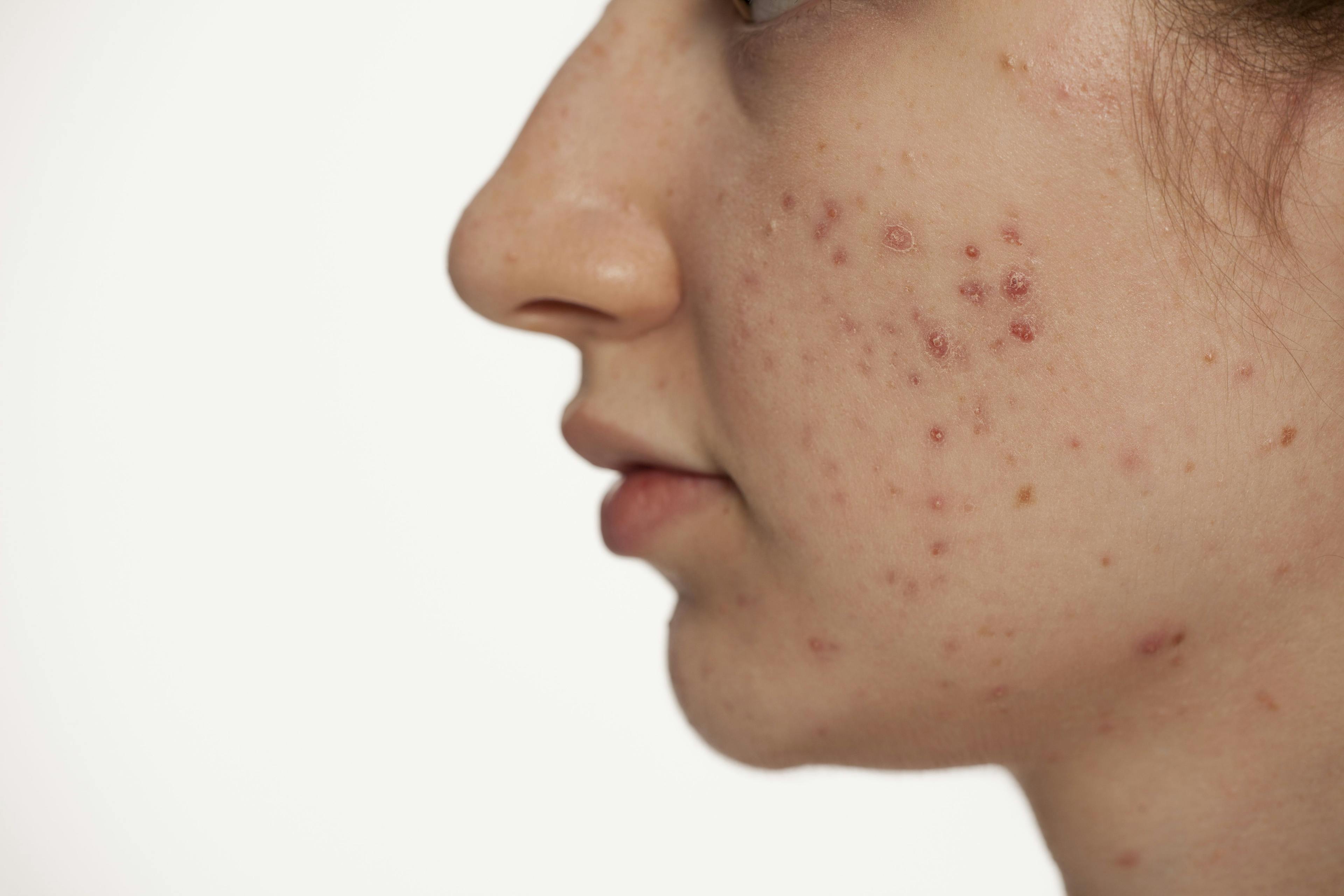 Join Dermatology Times® in Discussing Childhood Acne