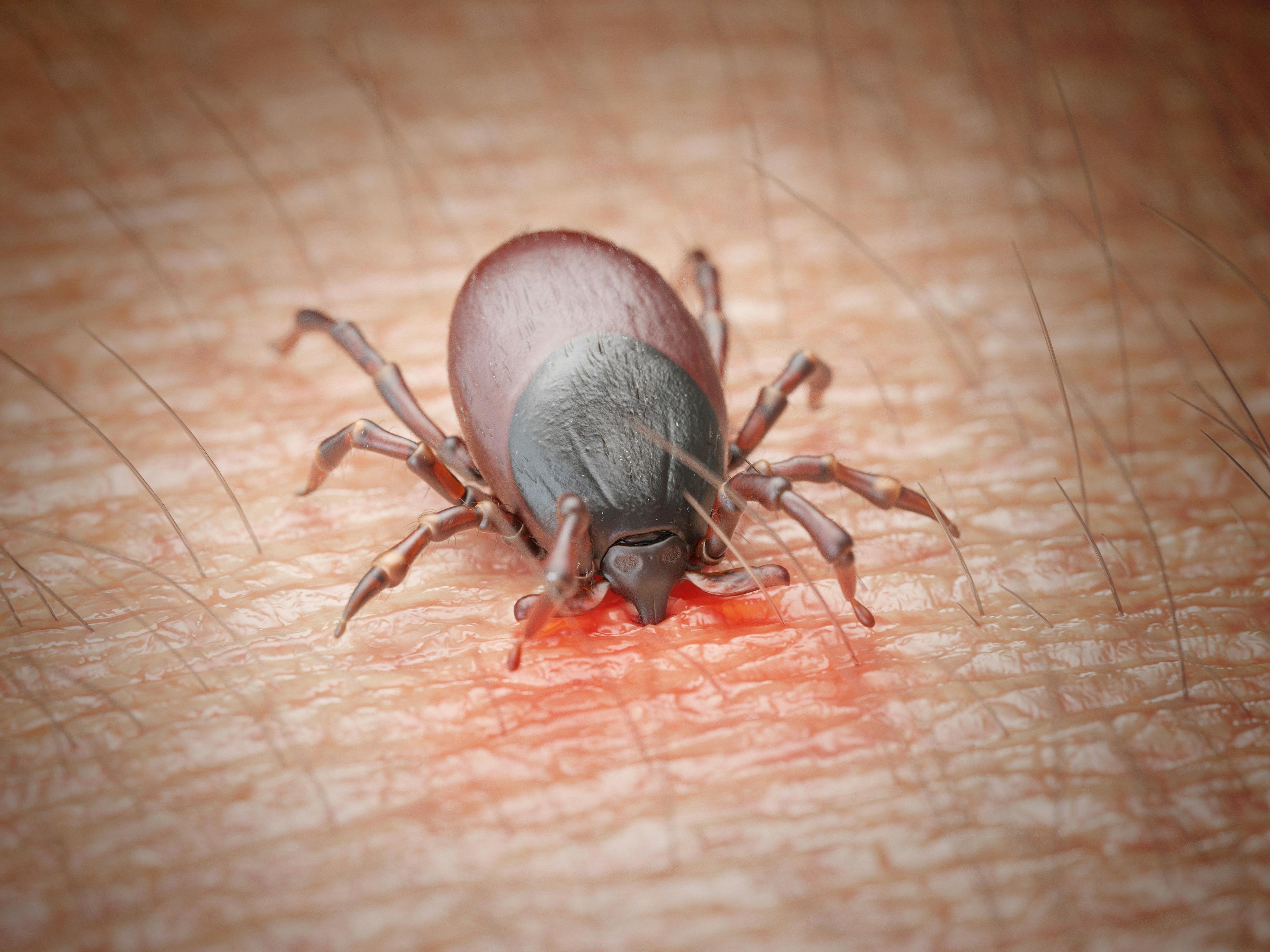 Lyme disease caused by tick bite.