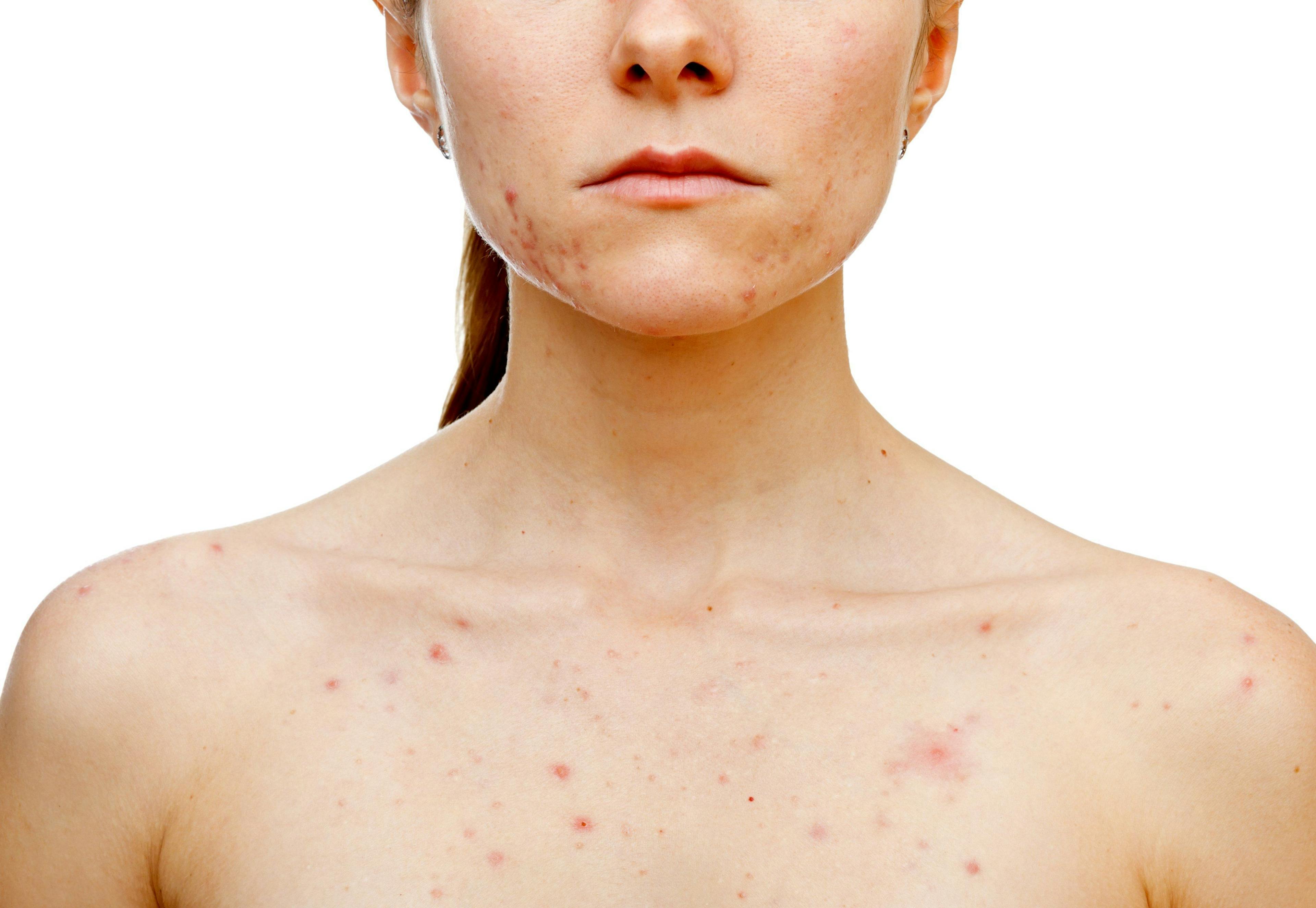 Narrow-spectrum antibiotics viable treatment option for acne