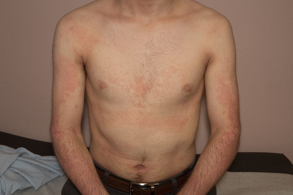 Atopic Dermatitis (©AnthonyRicci/Shutterstock.com)