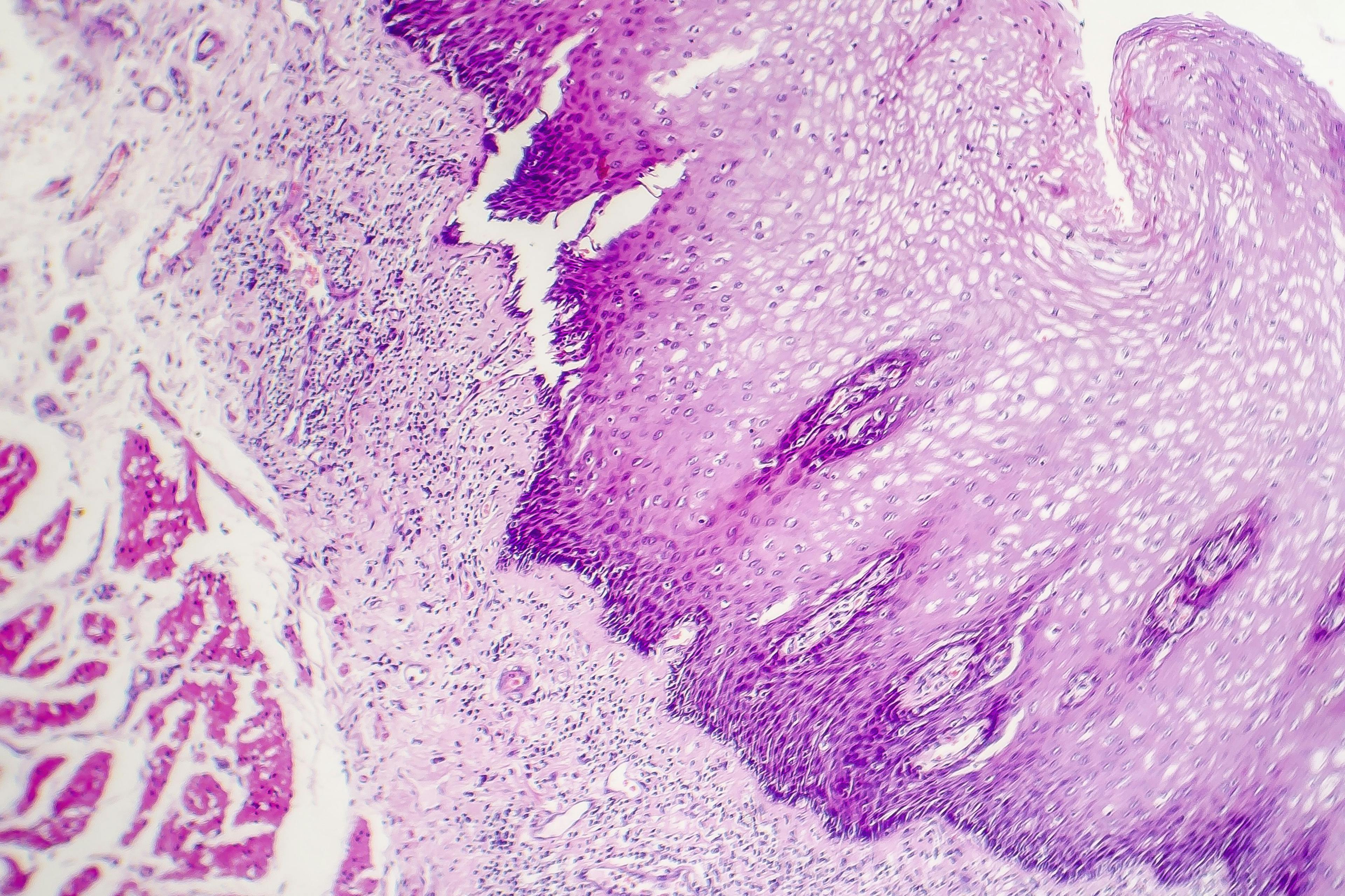 Mortality high in squamous cell carcinoma in hidradenitis suppurativa