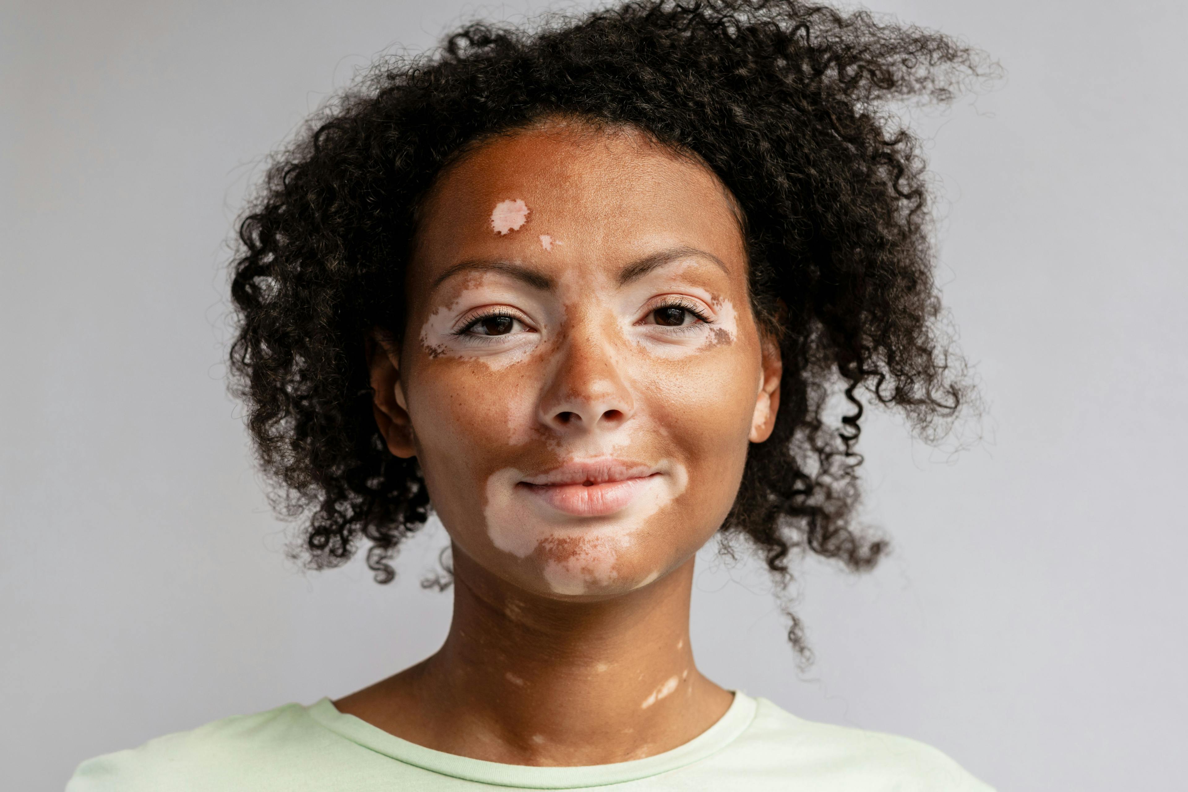 Diagnosing and Treating Different Pigmentation Disorders