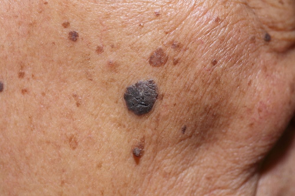 mole removal with laser