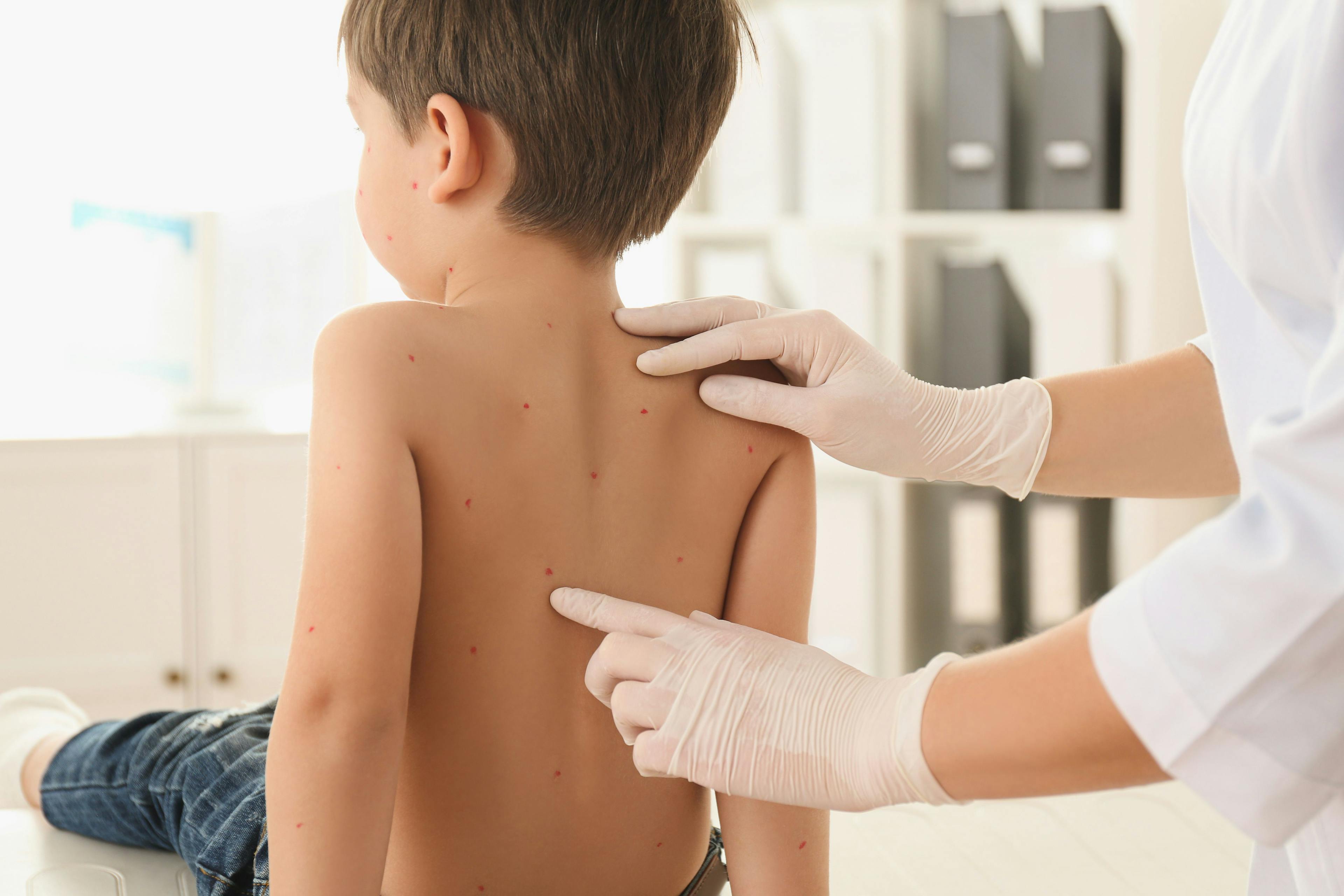 The Latest Updates in Pediatric Dermatology