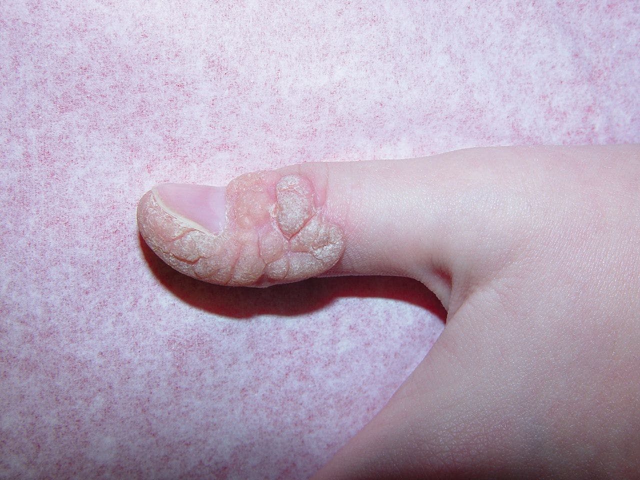 Koebner wart after combination Cantharidin