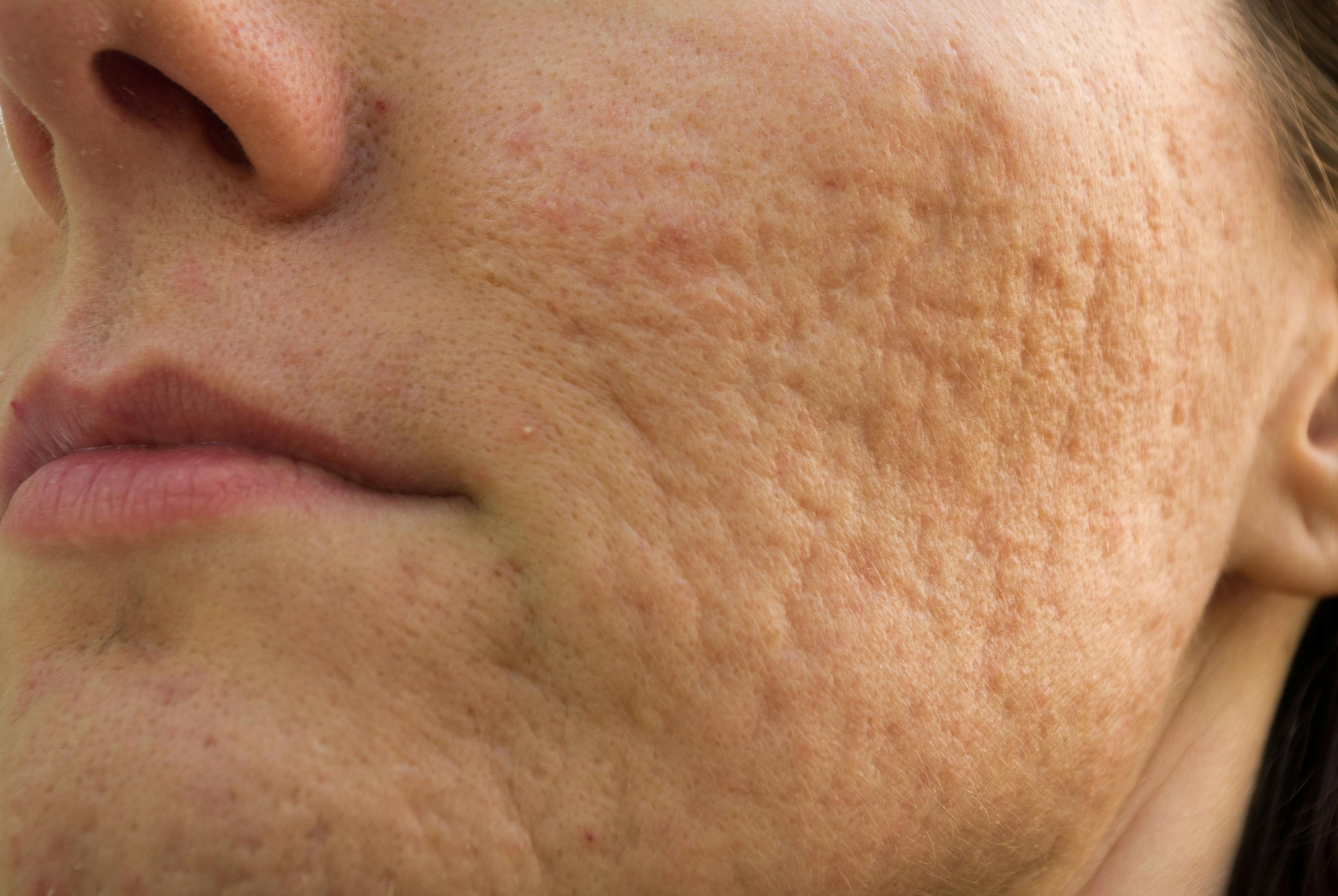 Acne May Impair Sleep Quality for Adult Patients