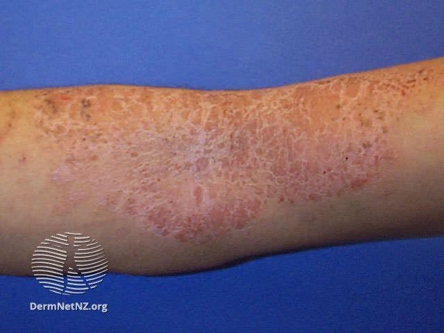 Atopic dermatitis

Image courtesy of DermNetZ