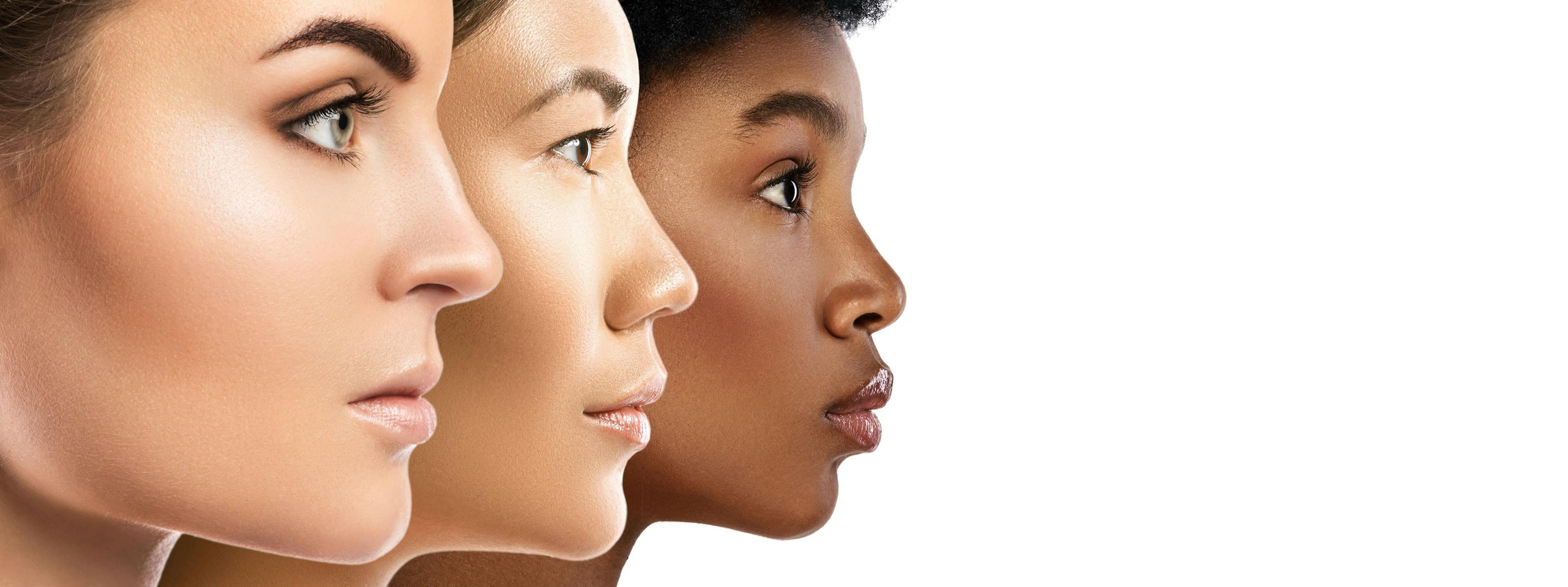 Racial Differences for Preferred Acne Care 