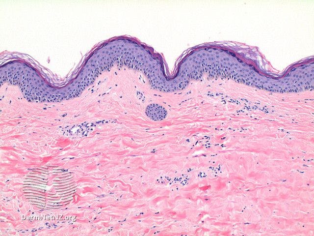 Lichen sclerosus pathology

Image courtesy of DermNet
