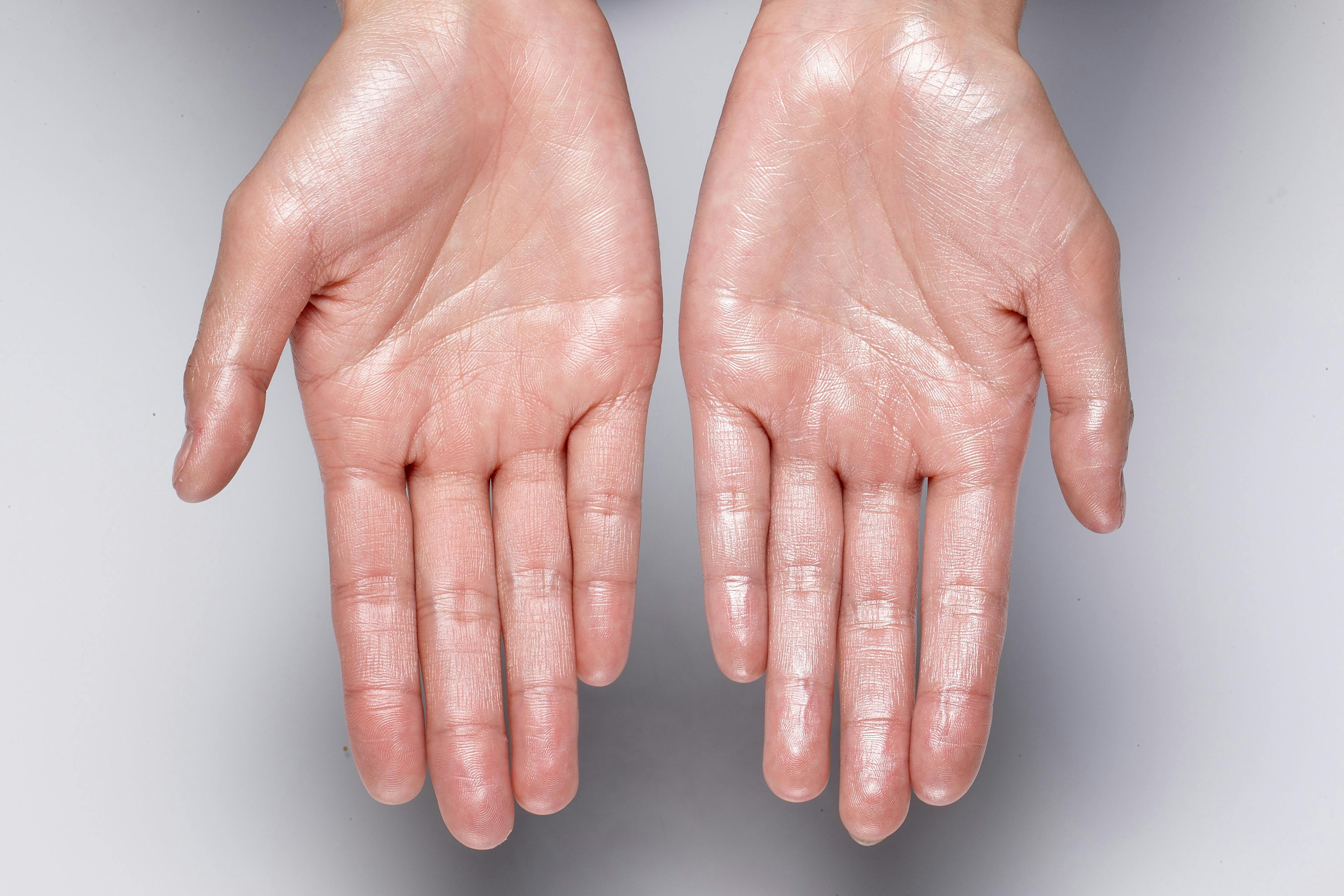 Patients With Palmar Hyperhidrosis Not Sweating Over Quality of Life With Oxybutynin