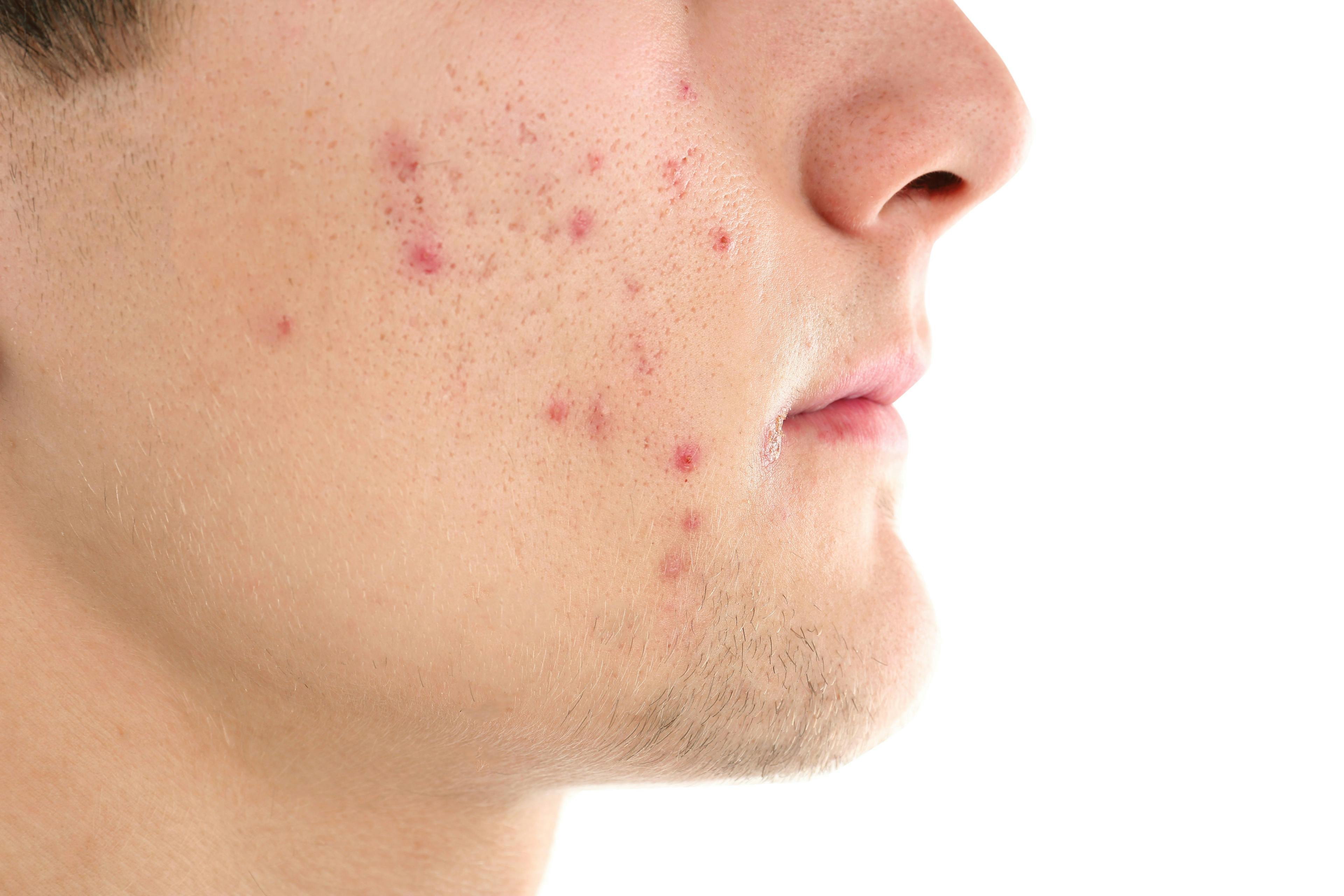 Does CBD Play a Role in Acne Treatment?