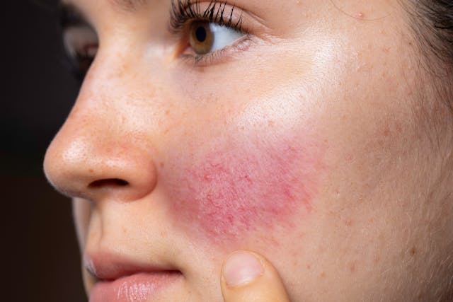 National Rosacea Society Conducts Survey on Persistent Facial Redness 