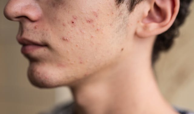 Acne Survey Reveals Only 3 in 10 Patients Have Gone to a Dermatologist for Treatment 