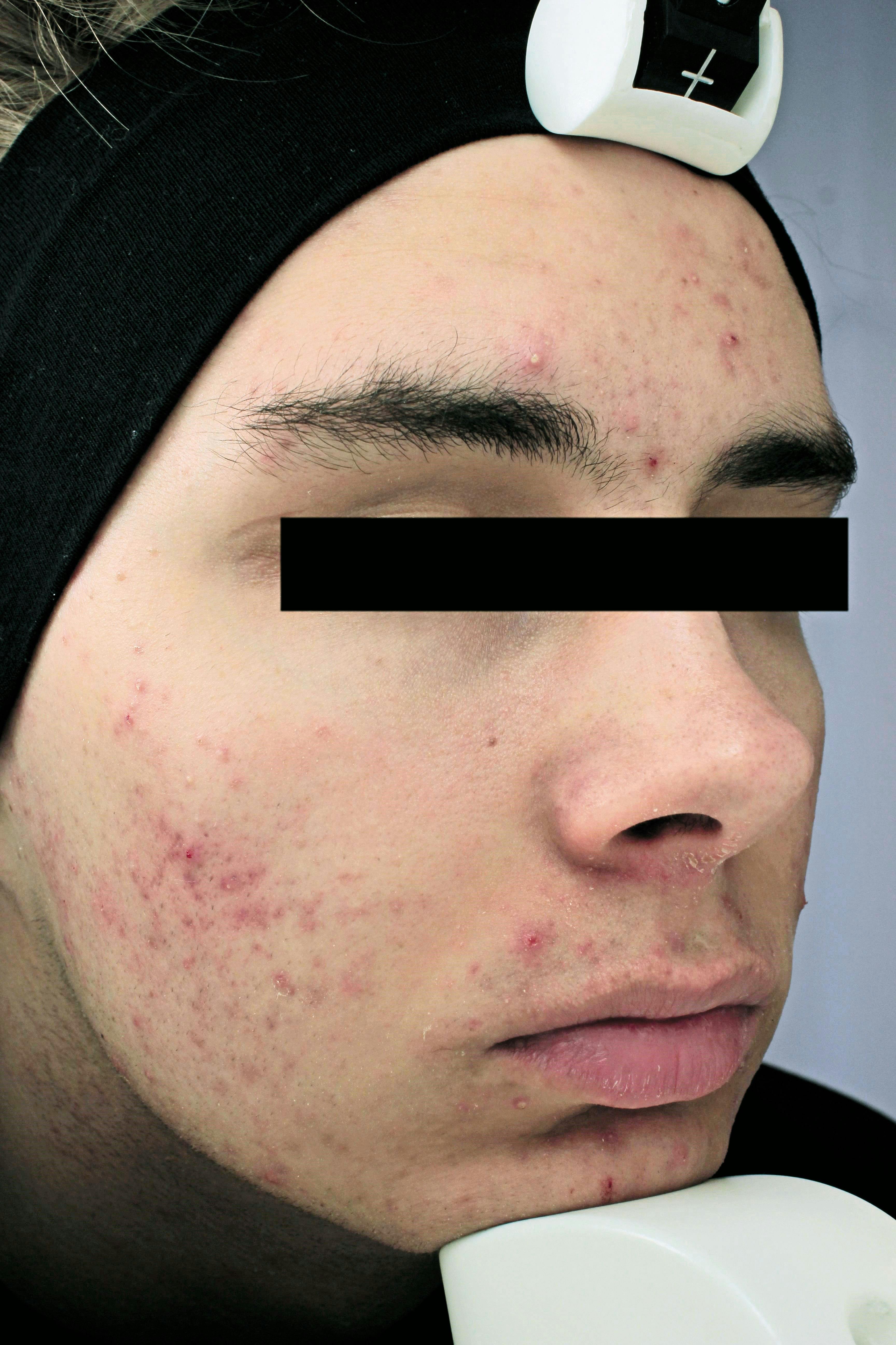 patient with acne