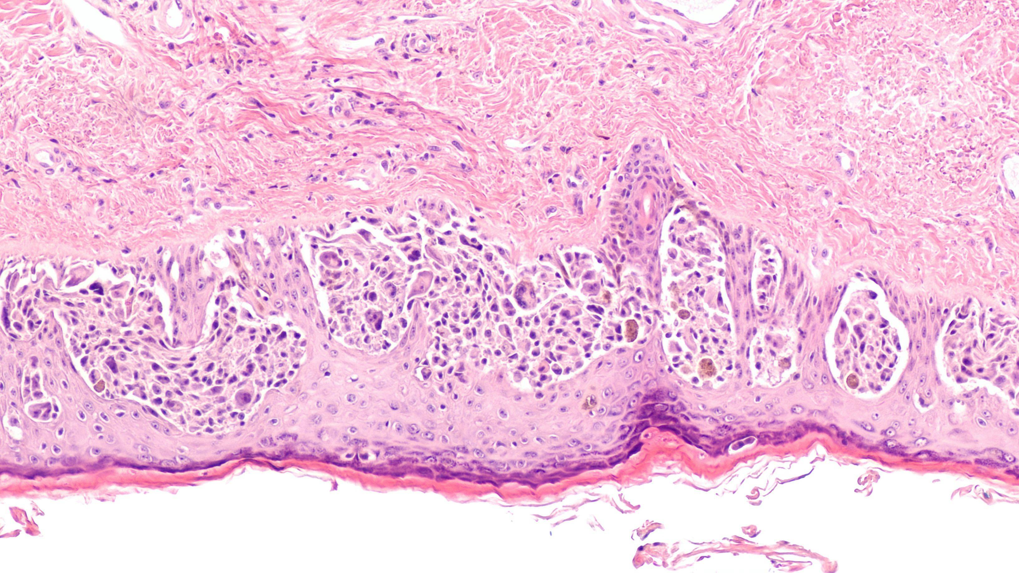 Lichen Sclerosus Present in 82% of Penile Melanomas