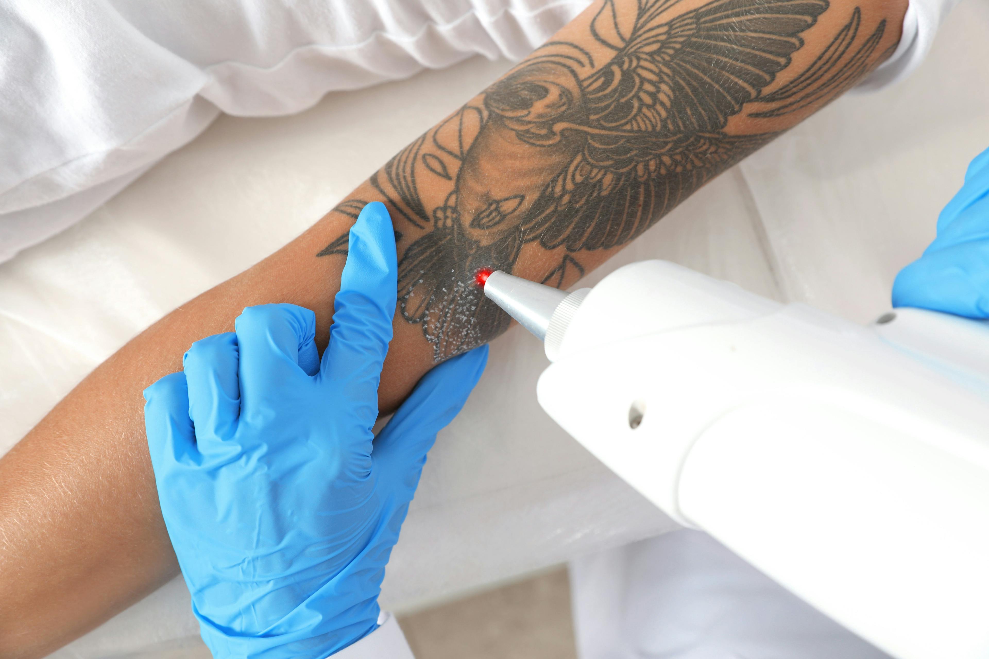 tattoo removal