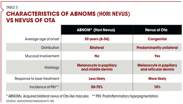 Table 3: Characteristics of ABNOMs (Hori’s Nevus) vs Nevus of Ota