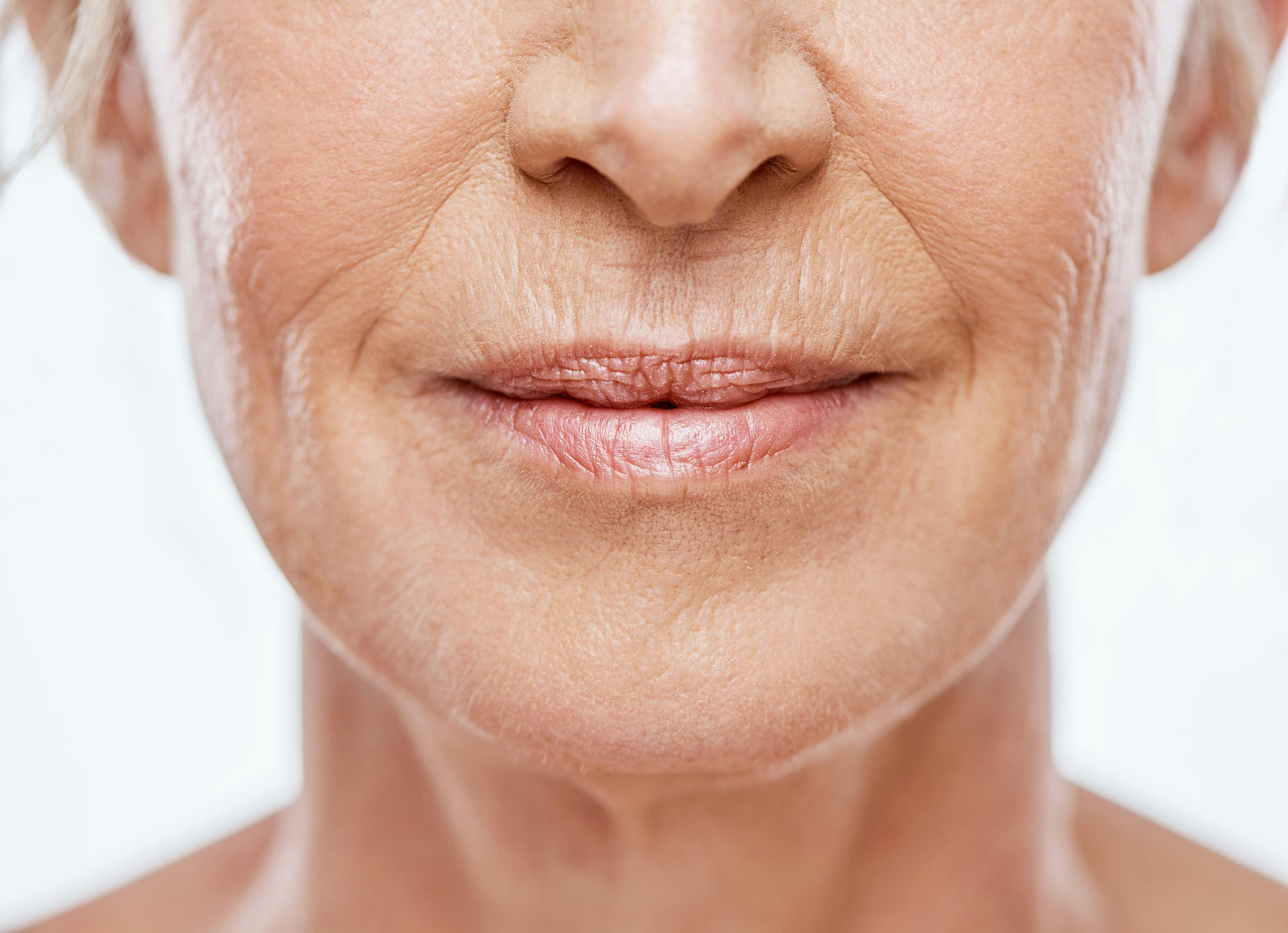 Sofwave Precise SUPERB Applicator FDA Cleared for Improving Facial Lines, Wrinkles