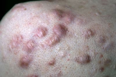 Combination therapies improve keloid treatment