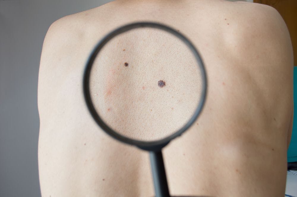 Genetic test could rule out melanoma diagnosis