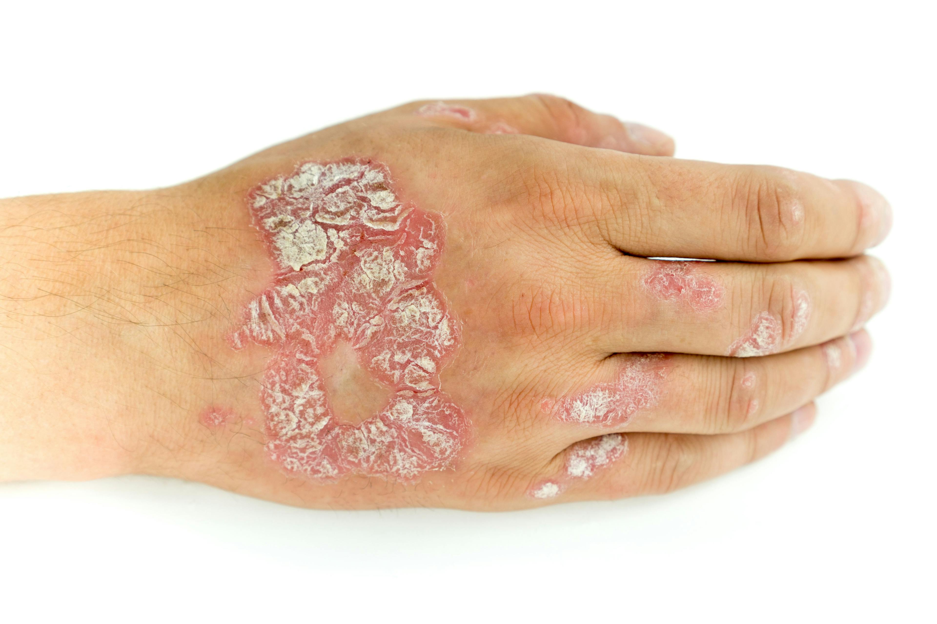 Tapinarof Cream 1% Led to Rapid Improvements in Itch for Adults With Mild to Severe Plaque Psoriasis