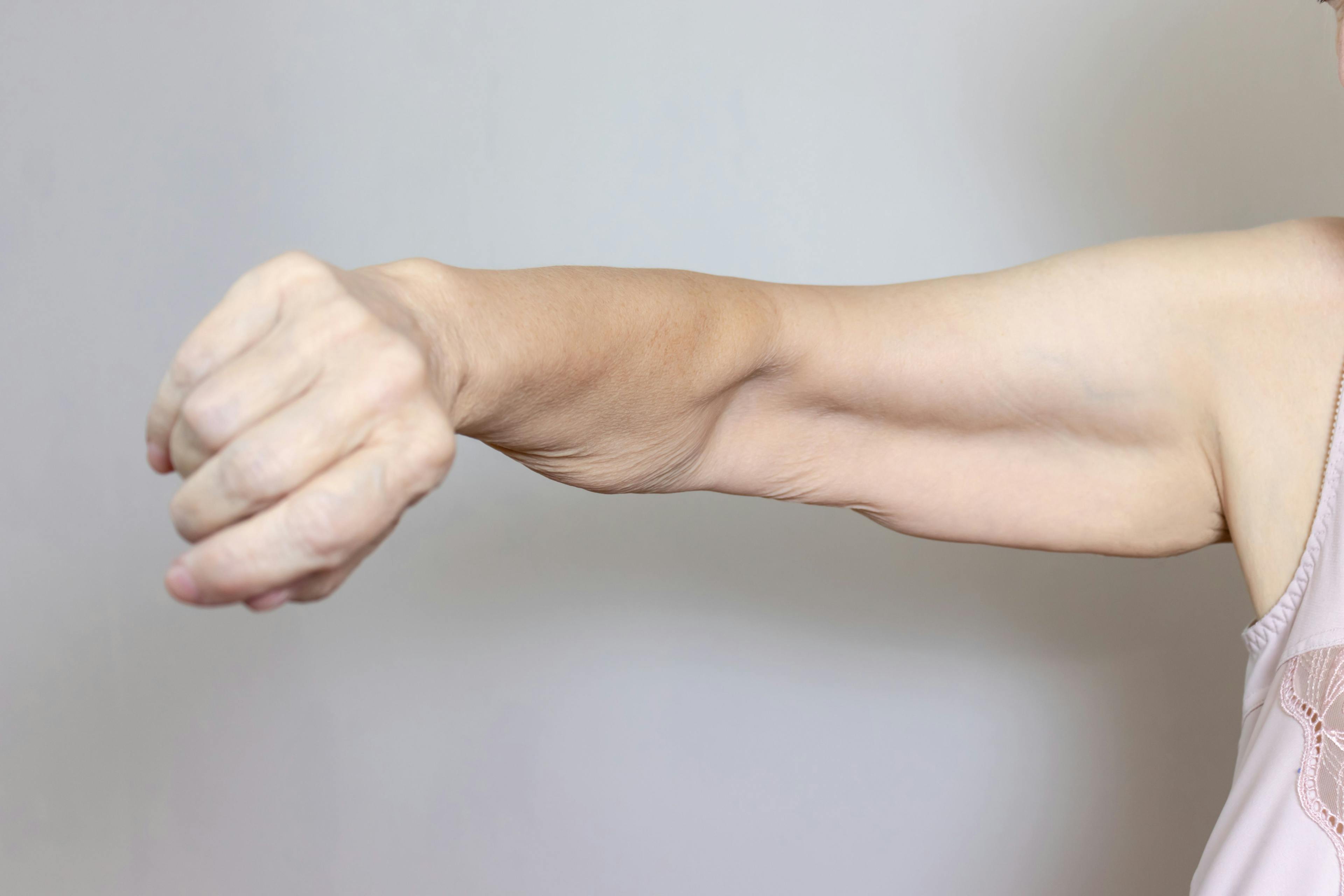 Single-Plane vs Double-Plane MFU-V for Upper Arm Skin Laxity