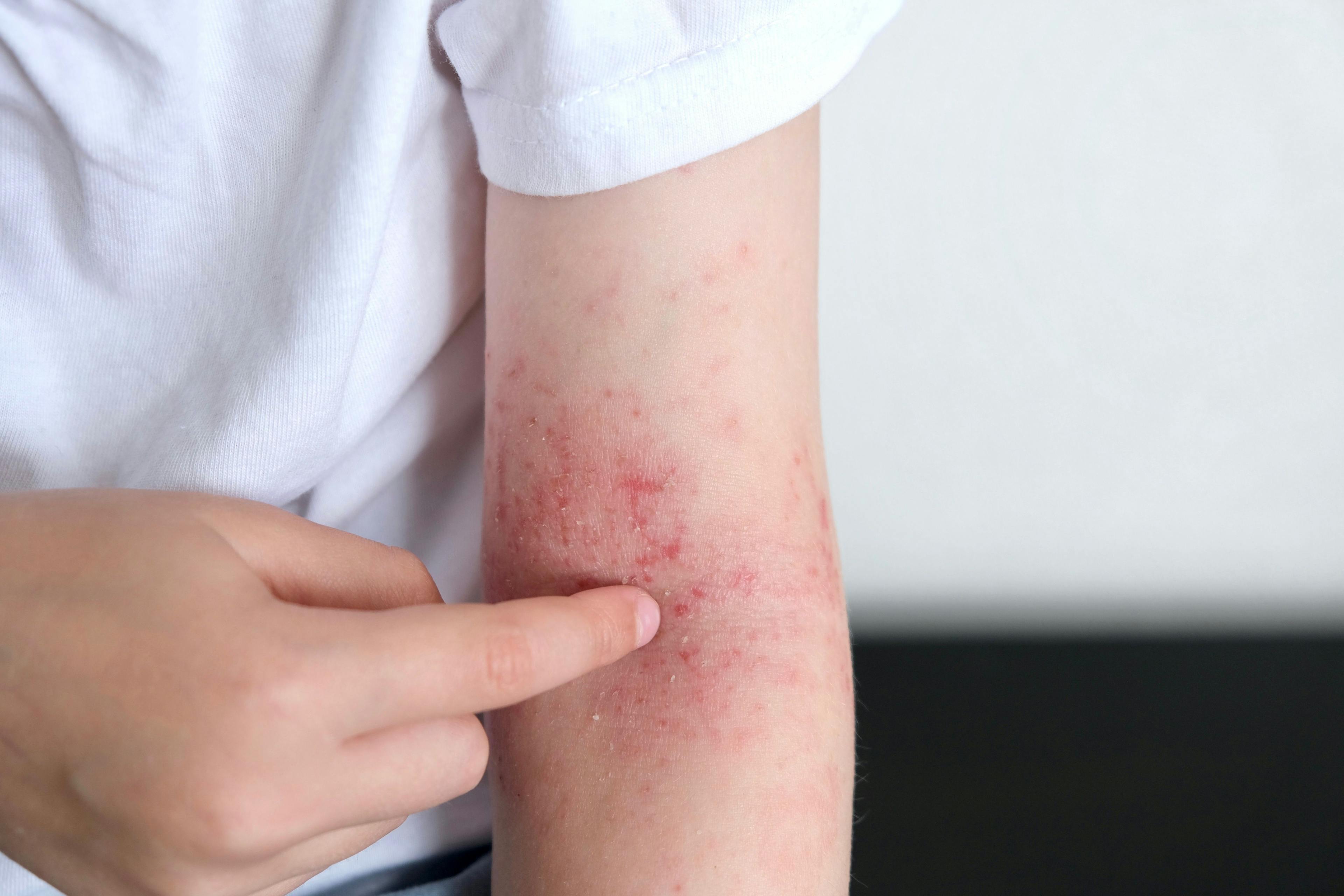 Abrocitinib Did Not Impact Immune Responses to Vaccination in Adolescents With Atopic Dermatitis