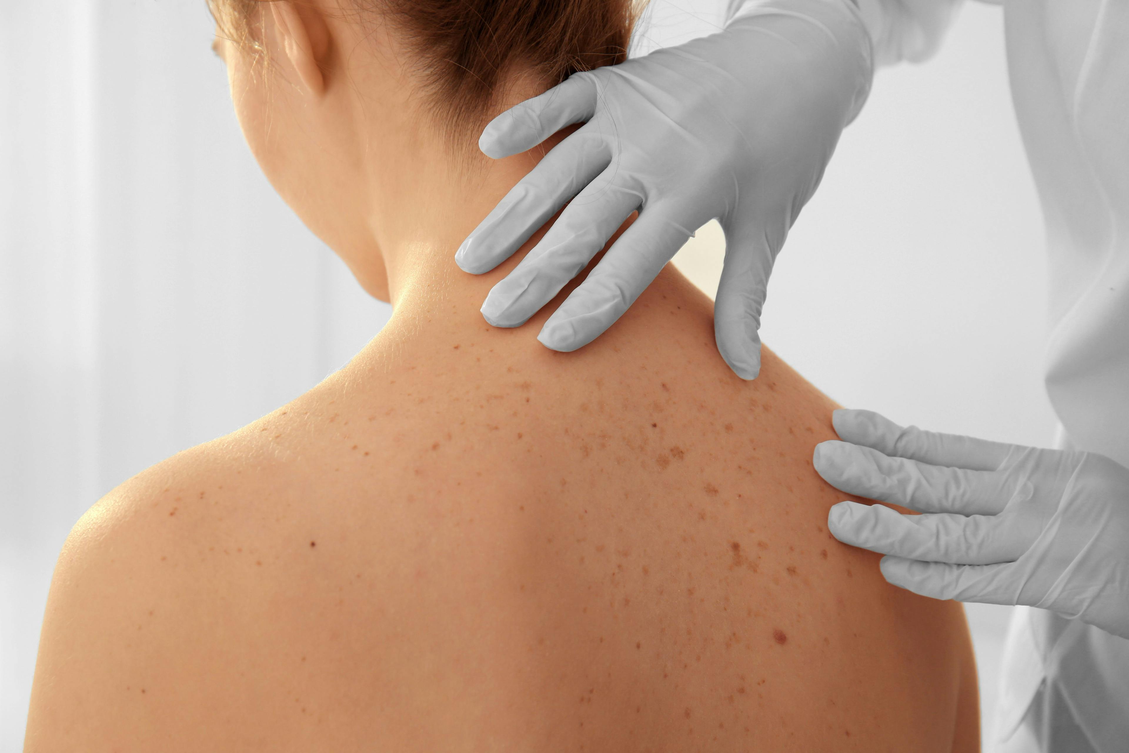 Study Reports Melanoma Overdiagnosis in White Patients  