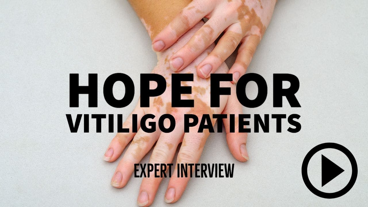 hands with vitiligo. Writing: Hope for vitiligo patients - expert interview.