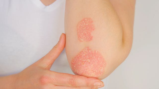 Which Patients With Psoriasis Will Develop Psoriatic Arthritis? 