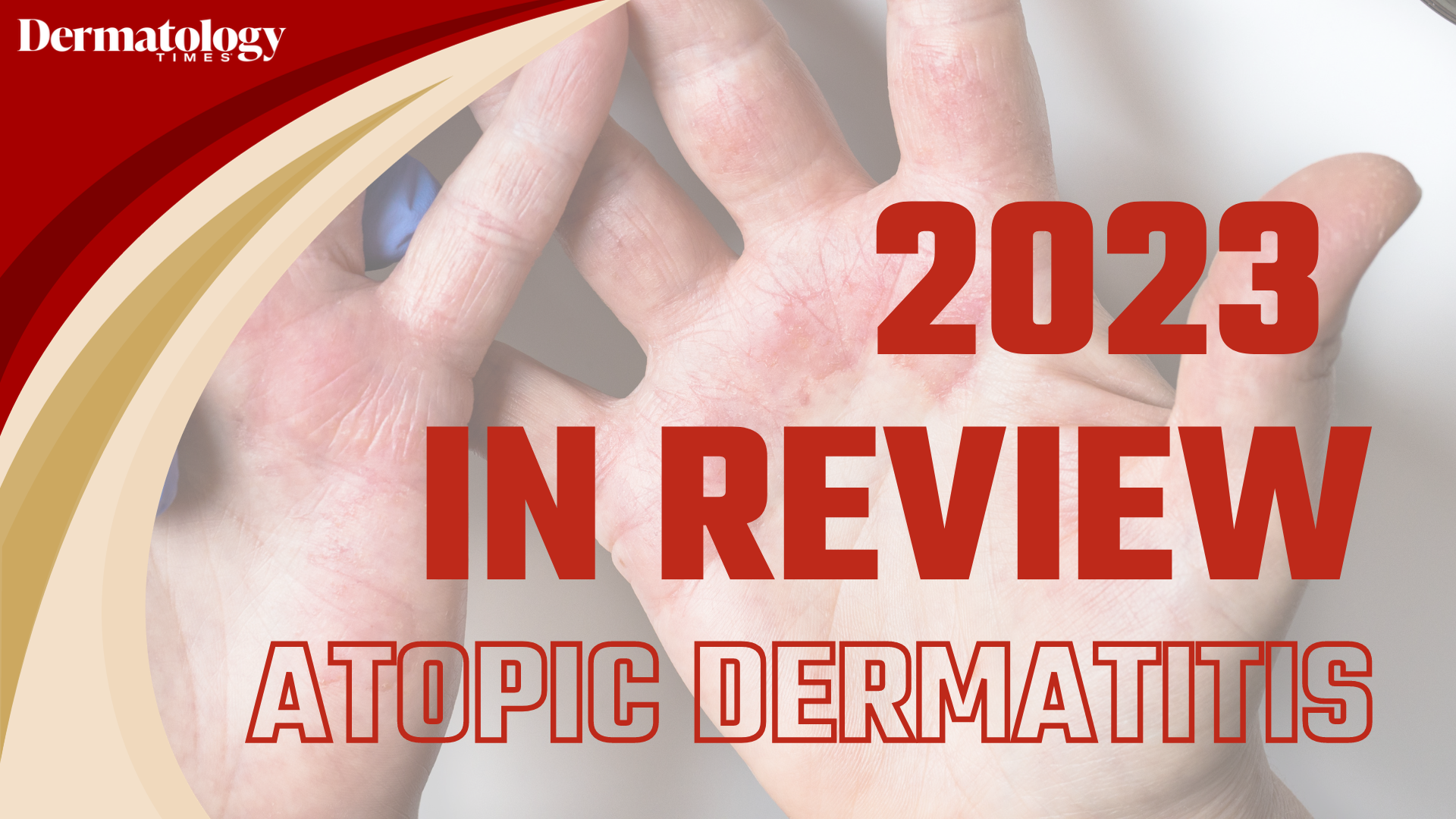 Dermatology Times 2023 In Review: Atopic Dermatitis