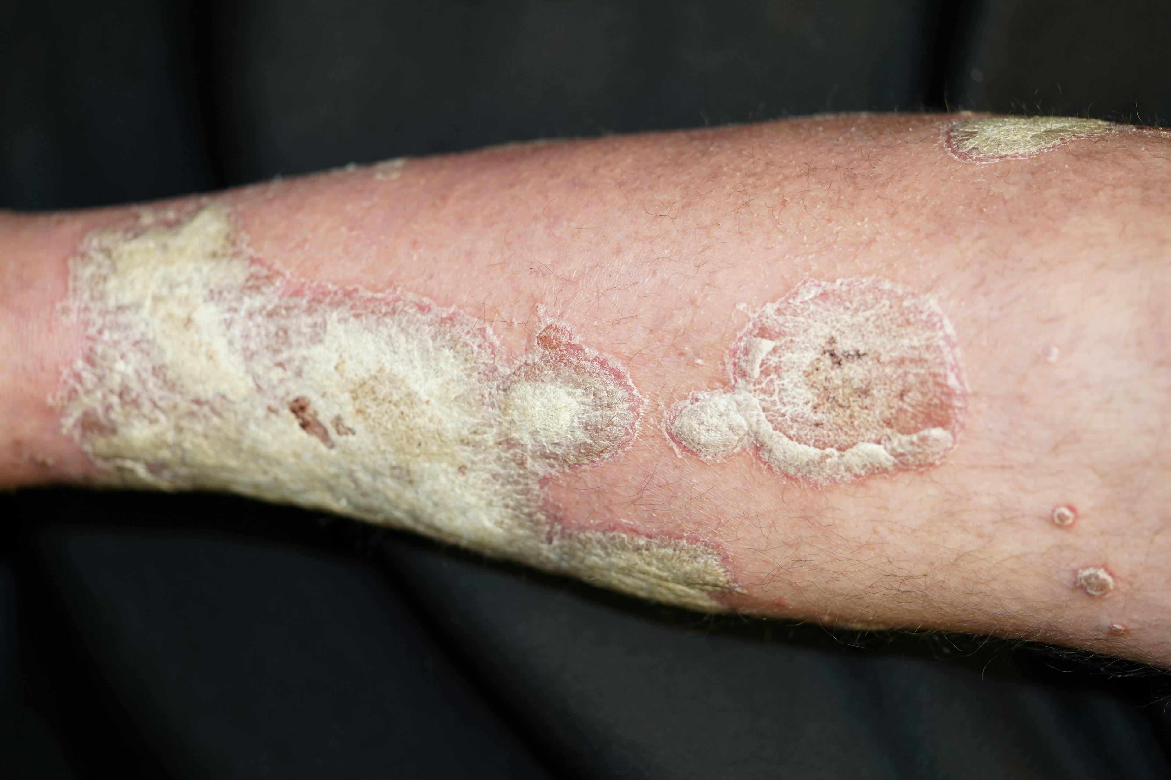 Based on efficacy and safety, as well as infrequent dosing, guselkumab may be a first-line, preferred treatment for patients with moderate-to-severe psoriasis.