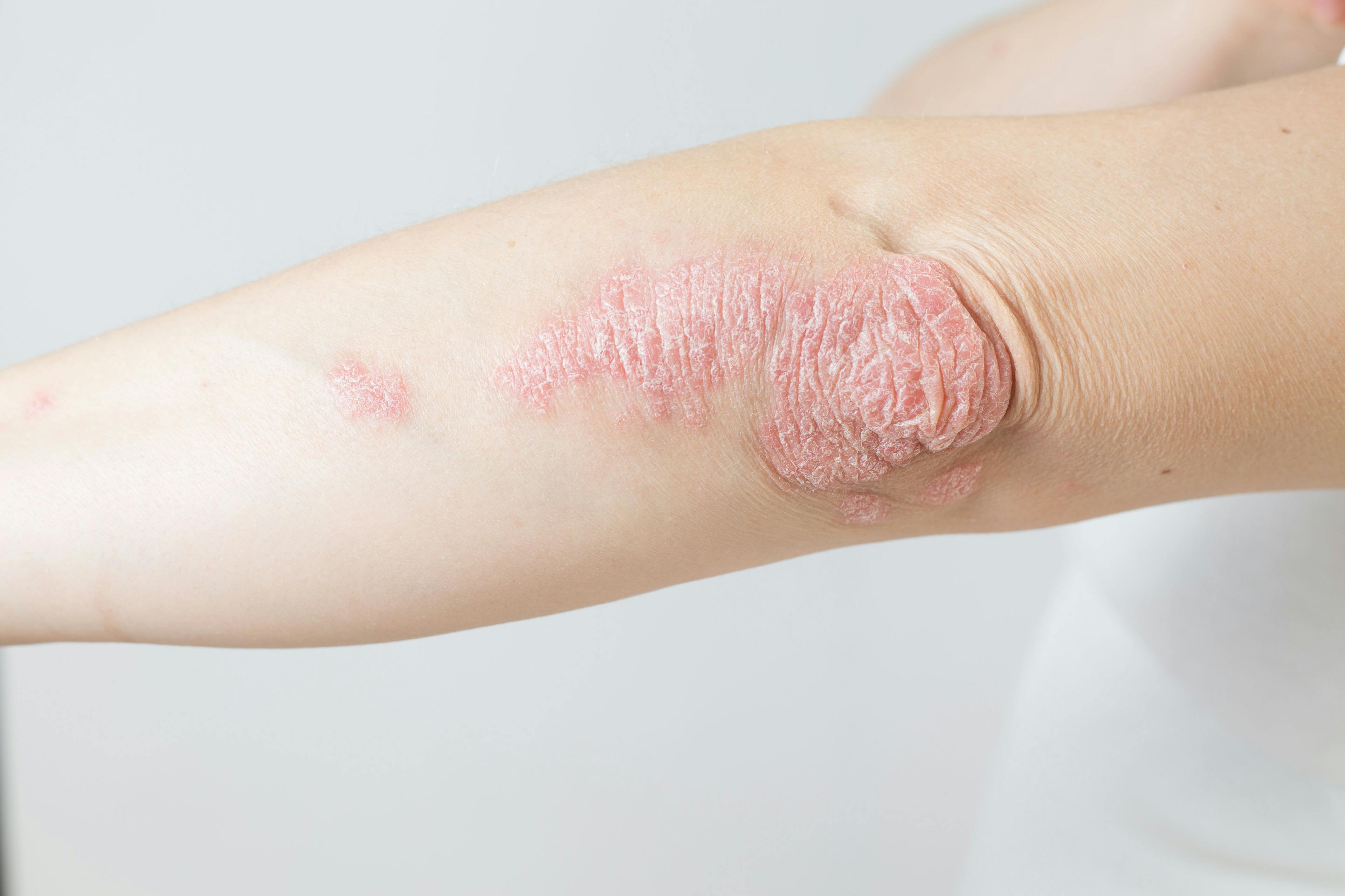 Pure Hypercholesterolemia and Psoriasis Share a Causal Link, Study Says