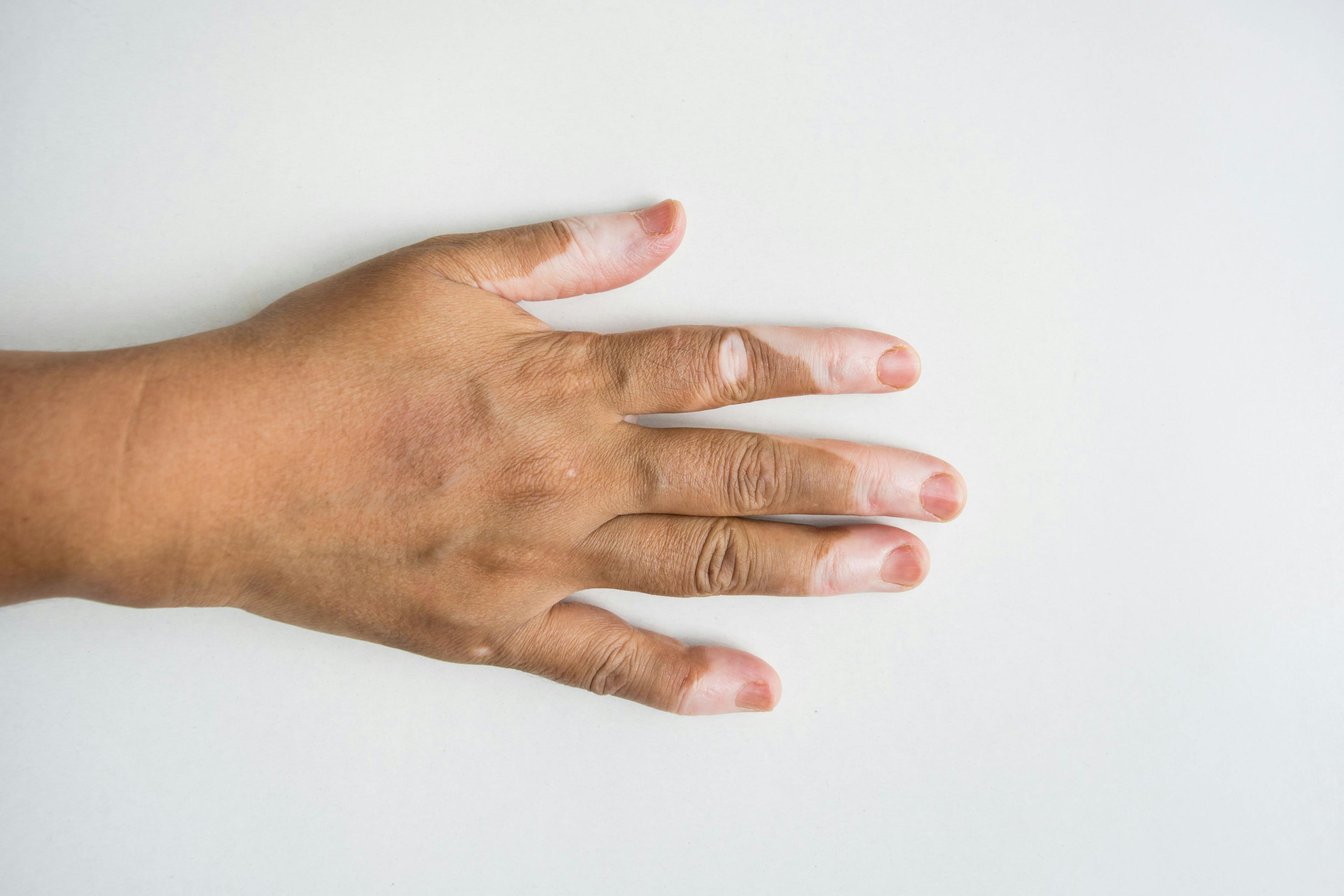 Hand with vitiligo on white background