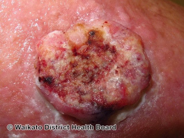 High-risk cutaneous squamous cell carcinoma

Image courtesy of the Waikato District Health Board and DermNetZ