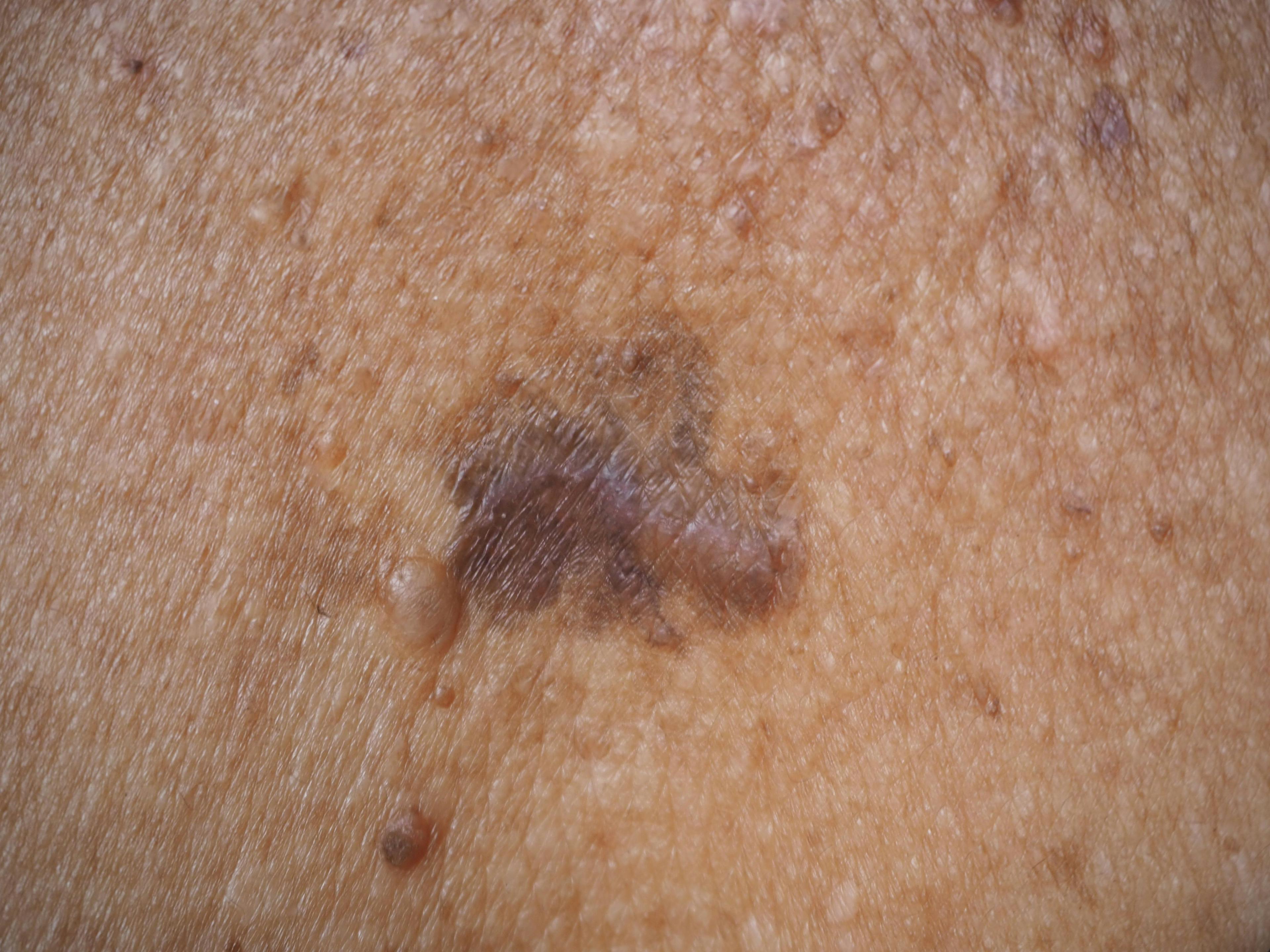 Study: Knowing Skin Cancer Risk May Limit Unhealthy Behavior