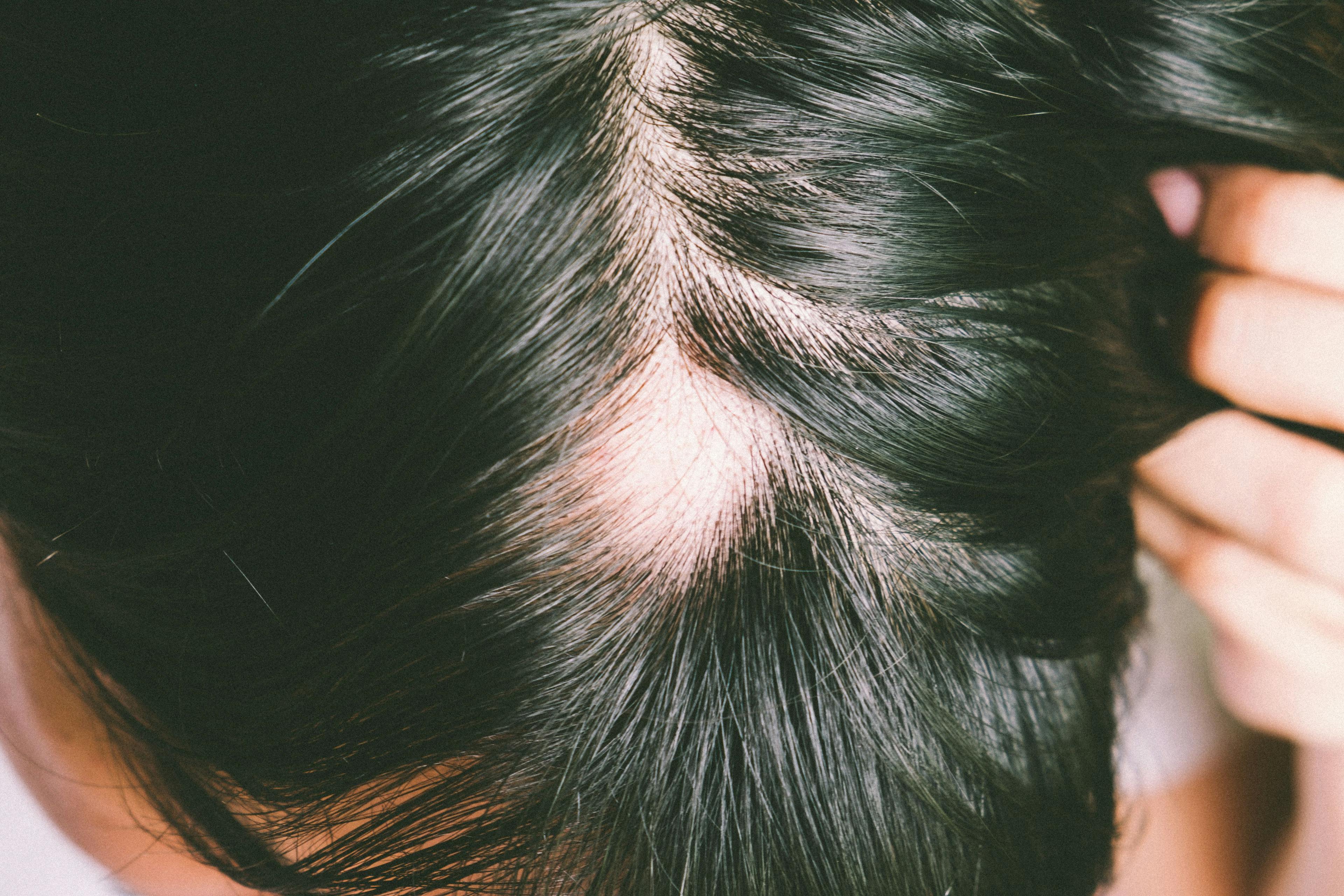 POLL: When Does Alopecia Areata Typically Develop? 